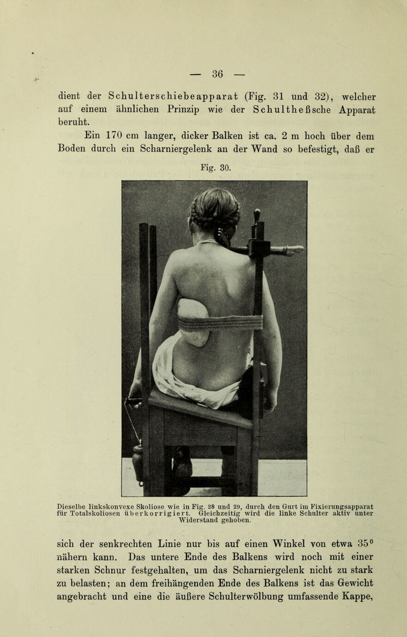 auf einem ähnlichen Prinzip wie der Schultheßsche Apparat beruht. Ein 170 cm langer, dicker Balken ist ca. 2 m hoch über dem Boden durch ein Scharniergelenk an der Wand so befestigt, daß er Fig. 30. Dieselbe linkskonvexe Skoliose wie in Fig. 28 und 29, durch den Gurt im Fixierungsapparat für Totalskoliosen üb er korrigiert. Gleichzeitig wird die linke Schulter aktiv unter Widerstand gehoben. sich der senkrechten Linie nur bis auf einen Winkel von etwa 35® nähern kann. Das untere Ende des Balkens wird noch mit einer starken Schnur festgehalten, um das Scharniergelenk nicht zu stark zu belasten; an dem freihängenden Ende des Balkens ist das Gewicht angebracht und eine die äußere Schulterwölbung umfassende Kappe,