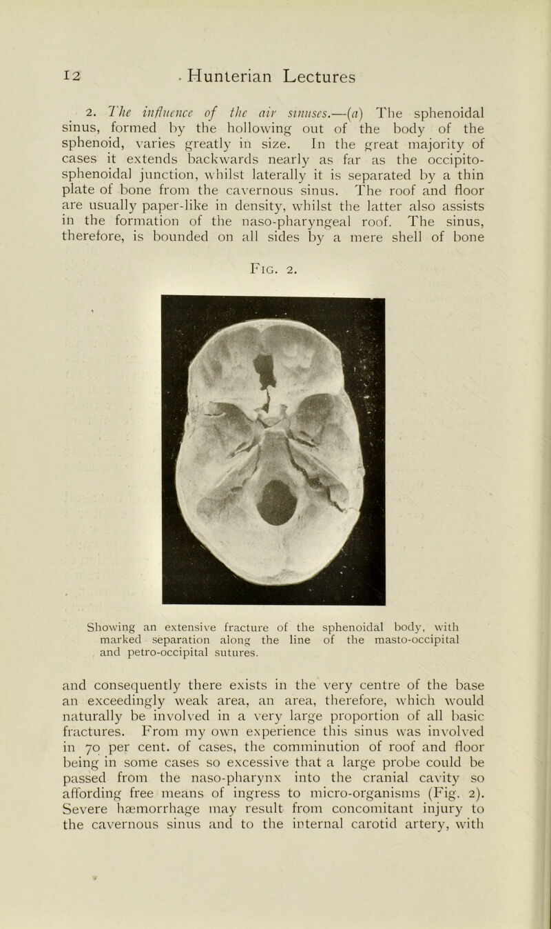 2. 1 he influence of the air sinuses.—(a) The sphenoidal sinus, formed by the hollowing out of the body of the sphenoid, varies greatly in size. In the great majority of cases it extends backwards nearly as far as the occipito- sphenoidal junction, whilst laterally it is separated by a thin plate of bone from the cavernous sinus. The roof and floor are usually paper-like in density, whilst the latter also assists in the formation of the naso-pharyngeal roof. The sinus, therefore, is bounded on all sides by a mere shell of bone Fig. 2. Showing an extensive fracture of the sphenoidal body, with marked separation along the line of the masto-occipital and petro-occipital sutures. and consequently there exists in the very centre of the base an exceedingly weak area, an area, therefore, which would naturally be involved in a very large proportion of all basic fractures. From my own experience this sinus was involved in 70 per cent, of cases, the comminution of roof and door being in some cases so excessive that a large probe could be passed from the naso-pharynx into the cranial cavity so affording free means of ingress to micro-organisms (Fig. 2). Severe haemorrhage may result from concomitant injury to the cavernous sinus and to the internal carotid artery, with