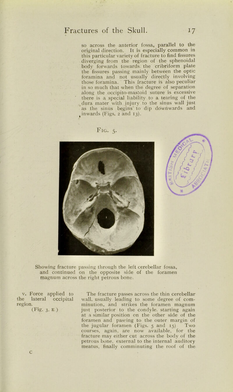 so across the anterior fossa, parallel to the original direction. It is especially common in this particular variety of fracture to find fissures diverging from the region of the sphenoidal body forwards towards, the cribriform plate the fissures passing mainly between the optic foramina and not usually directly involving those foramina. This fracture is also peculiar in so much that when the degree of separation along the occipito-mastoid suture is excessive there is a special liability to a tearing of the dura mater with injury to the sinus wall just as the sinus begins to dip downwards and t inwards (Figs. 2 and 13). Fig. 5. Showing fracture passing through the left cerebellar fossa, and continued on the opposite side of the foramen magnum across the right petrous bone. v. Force applied to the lateral occipital region. (Fig. 3, E ) The fracture passes across the thin cerebellar wall, usually leading to some degree of com- minution, and strikes the foramen magnum just posterior to the condyle, starting again at a similar position on the other side of the foramen and passing to the outer margin of the jugular foramen (Figs. 5 and 15) Two courses, again, are now available, for the fracture may either cut across the body of the petrous bone, external to the internal auditory meatus, finally comminuting the roof of the C