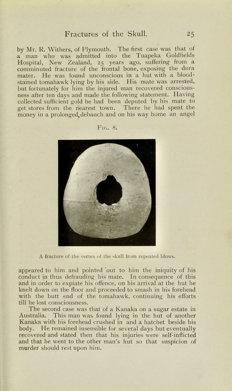 by Mr. R. Withers, of Plymouth. The first case was that of a man who was admitted into the Tuapeka Goldfields Hospital, New Zealand, 25 years ago, suffering from a comminuted fracture of the frontal bone, exposing the dura mater. He was found unconscious in a hut with a blood- stained tomahawk lying by his side. His mate was arrested, but fortunately for him the injured man recovered conscious- ness after ten days and made the following statement. Having collected sufficient gold he had been deputed by his mate to get stores from the nearest town. There he had spent the money in a prolonged* debauch and on his way home an angel Fig. 8. A fracture of the vertex of the skull from repeated blows. appeared to him and pointed out to him the iniquity of his conduct in thus defrauding his mate. In consequence of this and in order to expiate his offence, on his arrival at the hut he knelt down on the floor and proceeded to smash in his forehead with the butt end of the tomahawk, continuing his efforts till he lost consciousness. The second case was that of a Kanaka on a sugar estate in Australia. This man was found lying in the hut of another Kanaka with his forehead crushed in and a hatchet beside his body. He remained insensible for several days but eventually recovered and stated then that his injuries were self-inflicted and that he went to the other man’s hut so that suspicion of murder should rest upon him.