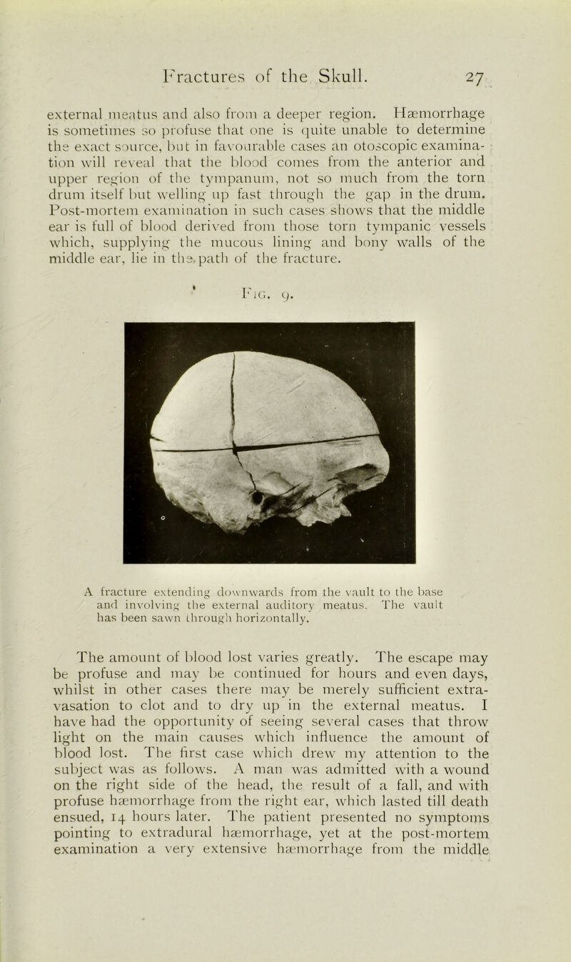 external meatus and also from a deeper region. Haemorrhage is sometimes so profuse that one is quite unable to determine the exact source, but in favourable cases an otoscopic examina- tion will reveal that the blood comes from the anterior and upper region of the tympanum, not so much from the torn drum itself but welling up fast through the gap in the drum. Post-mortem examination in such cases shows that the middle ear is full of blood derived from those torn tympanic vessels which, supplying the mucous lining and bony walls of the middle ear, lie in the.path of the fracture. Fig. 9. A fracture extending downwards from the vault to the base and involving the external auditory meatus. The vault has been sawn through horizontally. The amount of blood lost varies greatly. The escape may be profuse and may be continued for hours and even days, whilst in other cases there may be merely sufficient extra- vasation to clot and to dry up in the external meatus. I have had the opportunity of seeing several cases that throw light on the main causes which influence the amount of blood lost. The first case which drew my attention to the subject was as follows. A man was admitted with a wound on the right side of the head, the result of a fall, and with profuse haemorrhage from the right ear, which lasted till death ensued, 14 hours later. The patient presented no symptoms pointing to extradural haemorrhage, yet at the post-mortem examination a very extensive haemorrhage from the middle