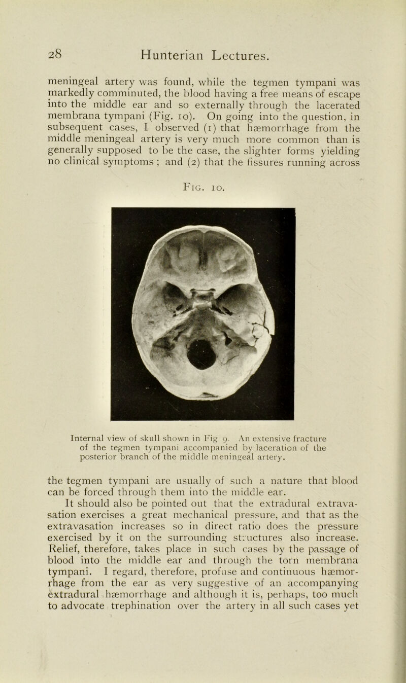 meningeal artery was found, while the tegmen tympani was markedly comminuted, the blood having a free means of escape into the middle ear and so externally through the lacerated membrana tympani (Fig. io). On going into the question, in subsequent cases, I observed (i) that haemorrhage from the middle meningeal artery is very much more common than is generally supposed to be the case, the slighter forms yielding no clinical symptoms ; and (2) that the fissures running across Fig. 10. Internal view of skull shown in Fig 9. An extensive fracture of the tegmen tympani accompanied by laceration of the posterior branch of the middle meningeal artery. the tegmen tympani are usually of such a nature that blood can be forced through them into the middle ear. It should also be pointed out that the extradural extrava- sation exercises a great mechanical pressure, and that as the extravasation increases so in direct ratio does the pressure exercised by it on the surrounding structures also increase. Relief, therefore, takes place in such cases by the passage of blood into the middle ear and through the torn membrana tympani. I regard, therefore, profuse and continuous haemor- rhage from the ear as very suggestive of an accompanying extradural haemorrhage and although it is, perhaps, too much to advocate trephination over the artery in all such cases yet