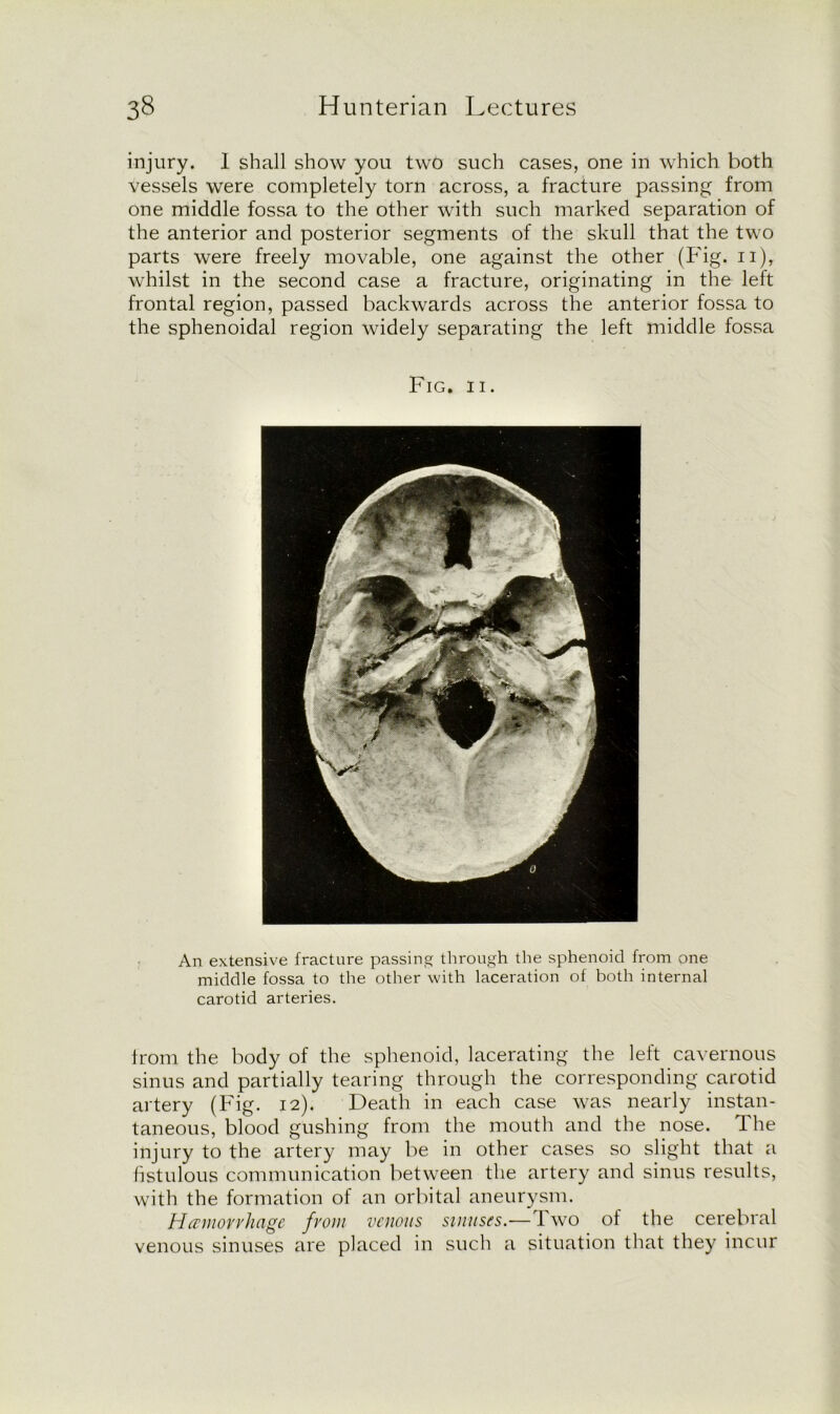 injury. I shall show you two such cases, one in which both vessels were completely torn across, a fracture passing from one middle fossa to the other with such marked separation of the anterior and posterior segments of the skull that the two parts were freely movable, one against the other (Fig. n), whilst in the second case a fracture, originating in the left frontal region, passed backwards across the anterior fossa to the sphenoidal region widely separating the left middle fossa Fig. ii. An extensive fracture passing through the sphenoid from one middle fossa to the other with laceration of both internal carotid arteries. from the body of the sphenoid, lacerating the left cavernous sinus and partially tearing through the corresponding carotid artery (Fig. 12). Death in each case was nearly instan- taneous, blood gushing from the mouth and the nose. The injury to the artery may be in other cases so slight that a fistulous communication between the artery and sinus results, with the formation of an orbital aneurysm. Hemorrhage from venous sinuses.—Two of the cerebral venous sinuses are placed in such a situation that they incur