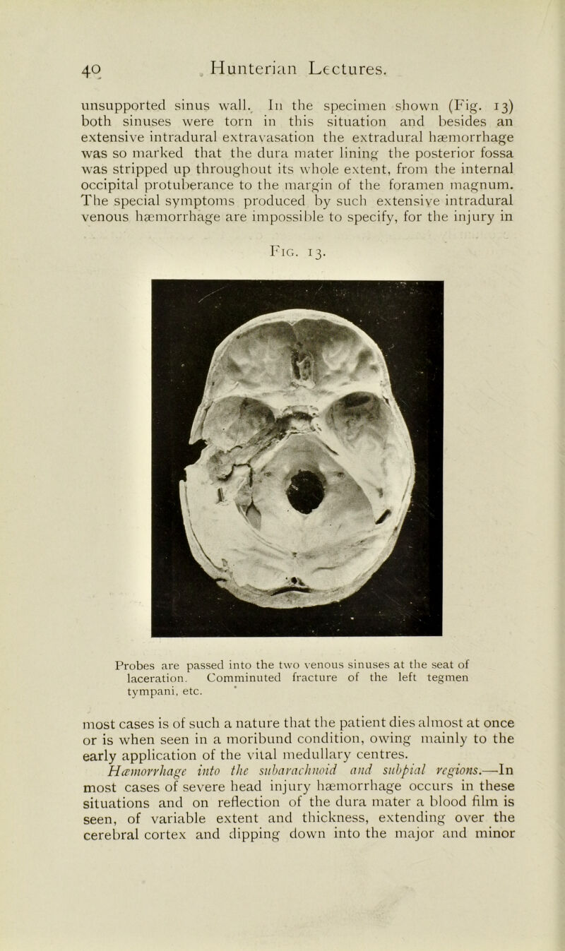 unsupported sinus wall. In the specimen shown (Fig. 13) both sinuses were torn in this situation and besides an extensive intradural extravasation the extradural haemorrhage was so marked that the dura mater lining the posterior fossa was stripped up throughout its whole extent, from the internal occipital protuberance to the margin of the foramen magnum. The special symptoms produced by such extensive intradural venous haemorrhage are impossible to specify, for the injury in Fig. 13. Probes are passed into the two venous sinuses at the seat of laceration. Comminuted fracture of the left tegmen tympani, etc. most cases is of such a nature that the patient dies almost at once or is when seen in a moribund condition, owing mainly to the early application of the vital medullary centres. Hemorrhage into the subarachnoid and subpial regions.—-In most cases of severe head injury haemorrhage occurs in these situations and on reflection of the dura mater a blood film is seen, of variable extent and thickness, extending over the cerebral cortex and dipping down into the major and minor