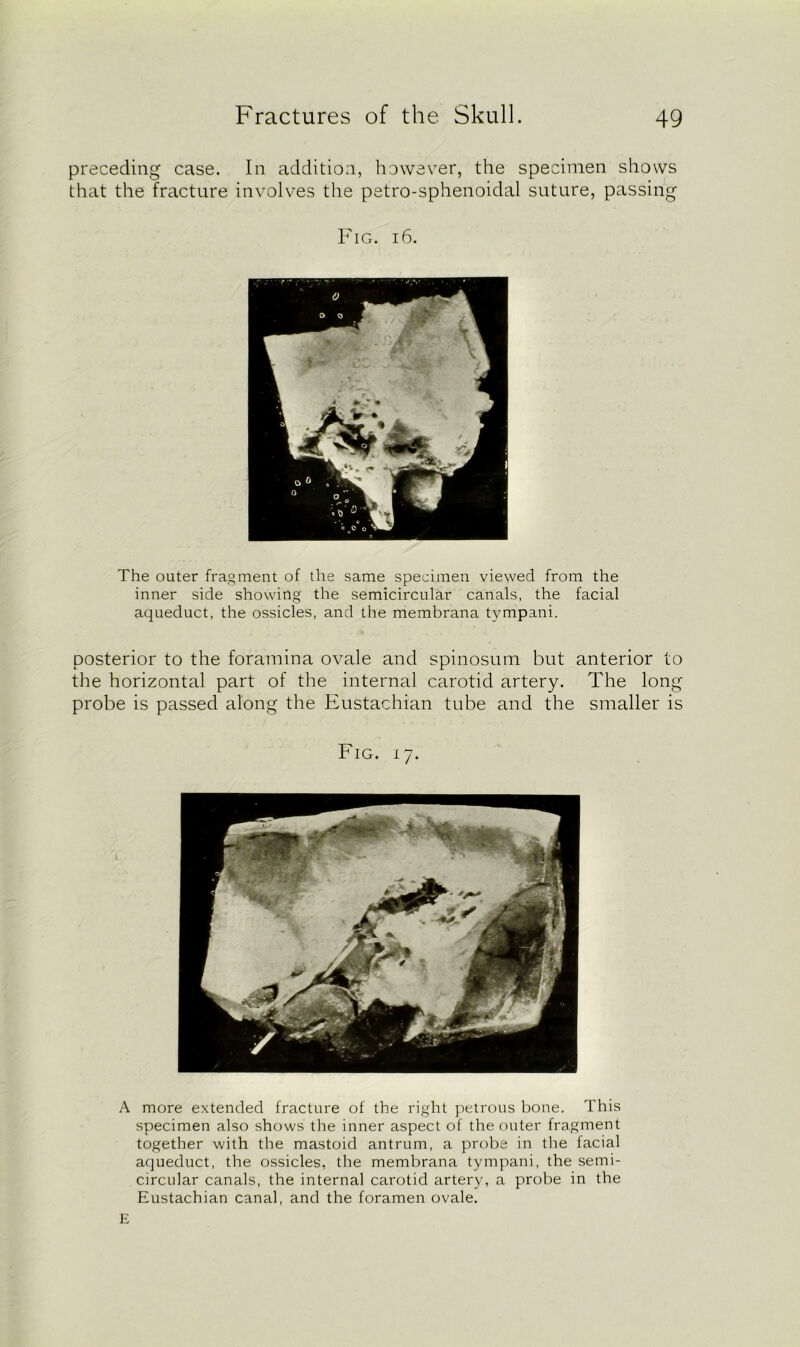 preceding case. In addition, however, the specimen shows that the fracture involves the petro-sphenoidal suture, passing Fig. 16. The outer fragment of the same specimen viewed from the inner side showing the semicircular canals, the facial aqueduct, the ossicles, and the membrana tympani. posterior to the foramina ovale and spinosum but anterior to the horizontal part of the internal carotid artery. The long probe is passed along the Eustachian tube and the smaller is Fig. i 7. A more extended fracture of the right petrous bone. This specimen also shows the inner aspect of the outer fragment together with the mastoid antrum, a probe in the facial aqueduct, the ossicles, the membrana tympani, the semi- circular canals, the internal carotid artery, a probe in the Eustachian canal, and the foramen ovale. E