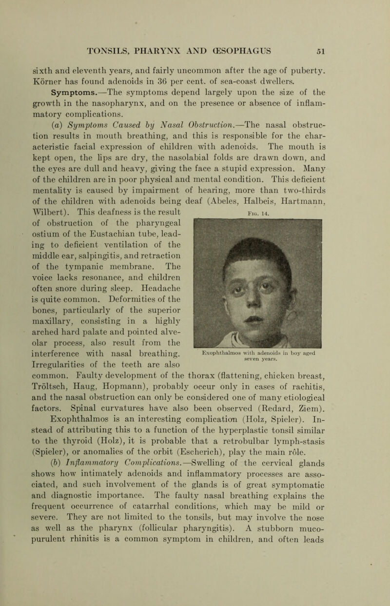 sixth and eleventh years, and fairly uncommon after the age of puberty. Korner has found adenoids in 36 per cent, of sea-coast dwellers. Symptoms.—The symptoms depend largely upon the size of the growth in the nasopharynx, and on the presence or absence of inflam- matory complications. (a) Symptoms Caused by Nasal Obstruction.—The nasal obstruc- tion results in mouth breathing, and this is responsible for the char- acteristic facial expression of children with adenoids. The mouth is kept open, the lips are dry, the nasolabial folds are drawn down, and the eyes are dull and heavy, giving the face a stupid expression. Many of the children are in poor physical and mental condition. This deficient mentality is caused by impairment of hearing, more than two-thirds of the children with adenoids being deaf (Abeles, Halbeis, Hartmann, Wilbert). This deafness is the result of obstruction of the pharyngeal ostium of the Eustachian tube, lead- ing to deficient ventilation of the middle ear, salpingitis, and retraction of the tympanic membrane. The voice lacks resonance, and children often snore during sleep. Headache is quite common. Deformities of the bones, particularly of the superior maxillary, consisting in a highly arched hard palate and pointed alve- olar process, also result from the Fig. 14. interference with nasal breathing. Exophthalmos with adenoids in boy aged seven years. Irregularities of the teeth are also common. Faulty development of the thorax (flattening, chicken breast, Troltsch, Haug, Hopmann), probably occur only in cases of rachitis, and the nasal obstruction can only be considered one of many etiological factors. Spinal curvatures have also been observed (Redard, Ziem). Exophthalmos is an interesting complication (Holz, Spieler). In- stead of attributing this to a function of the hyperplastic tonsil similar to the thyroid (Holz), it is probable that a retrobulbar lymph-stasis (Spieler), or anomalies of the orbit (Escherich), play the main role. (ib) Inflammatory Complications.—Swelling of the cervical glands shows how intimately adenoids and inflammatory processes are asso- ciated, and such involvement of the glands is of great symptomatic and diagnostic importance. The faulty nasal breathing explains the frequent occurrence of catarrhal conditions, which may be mild or severe. They are not limited to the tonsils, but may involve the nose as well as the pharynx (follicular pharyngitis). A stubborn muco- purulent rhinitis is a common symptom in children, and often leads