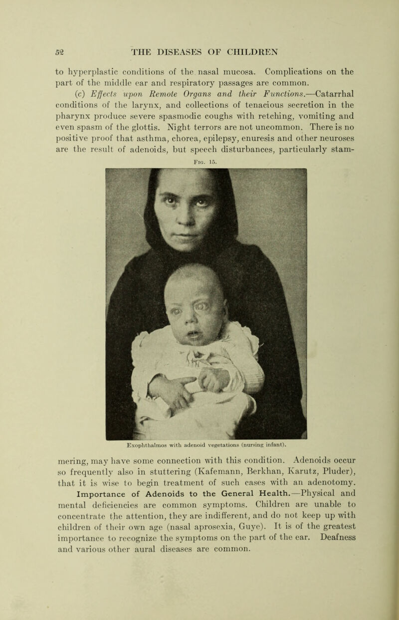 to hyperplastic conditions of the nasal mucosa. Complications on the part of the middle ear and respiratory passages are common. (c) Effects upon Remote Organs and their Functions.—Catarrhal conditions of the larynx, and collections of tenacious secretion in the pharynx produce severe spasmodic coughs with retching, vomiting and even spasm of the glottis. Night terrors are not uncommon. There is no positive proof that asthma, chorea, epilepsy, enuresis and other neuroses are the result of adenoids, but speech disturbances, particularly stam- Fig. 15. Exophthalmos with adenoid vegetations (nursing infant). mering, may have some connection with this condition. Adenoids occur so frequently also in stuttering (Kafemann, Berkhan, Karutz, Pluder), that it is wise to begin treatment of such cases with an adenotomy. Importance of Adenoids to the General Health.—Physical and mental deficiencies are common symptoms. Children are unable to concentrate the attention, they are indifferent, and do not keep up with children of their own age (nasal aprosexia, Guye). It is of the greatest importance to recognize the symptoms on the part of the ear. Deafness and various other aural diseases are common.