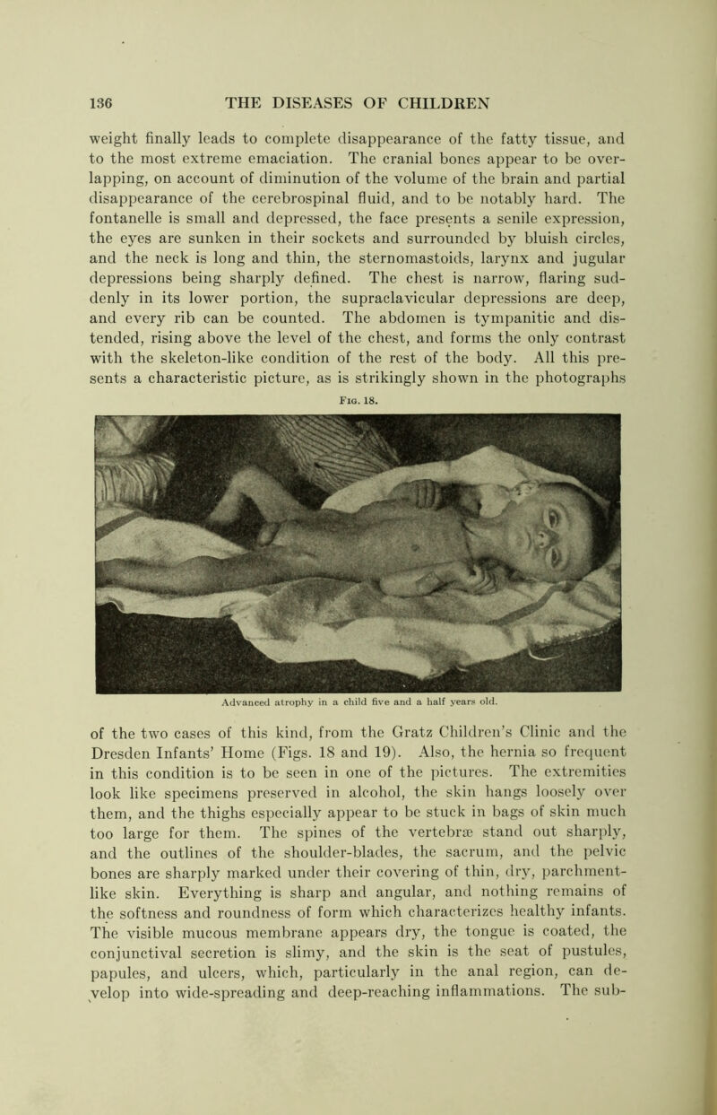 weight finally leads to complete disappearance of the fatty tissue, and to the most extreme emaciation. The cranial bones appear to be over- lapping, on account of diminution of the volume of the brain and partial disappearance of the cerebrospinal fluid, and to be notably hard. The fontanelle is small and depressed, the face presents a senile expression, the eyes are sunken in their sockets and surrounded by bluish circles, and the neck is long and thin, the sternomastoids, larynx and jugular depressions being sharply defined. The chest is narrow, flaring sud- denly in its lower portion, the supraclavicular depressions are deep, and every rib can be counted. The abdomen is tympanitic and dis- tended, rising above the level of the chest, and forms the only contrast with the skeleton-like condition of the rest of the body. All this pre- sents a characteristic picture, as is strikingly shown in the photographs Fig. 18. Advanced atrophy in a child five and a half years old. of the two cases of this kind, from the Gratz Children’s Clinic and the Dresden Infants’ Home (Figs. 18 and 19). Also, the hernia so frequent in this condition is to be seen in one of the pictures. The extremities look like specimens preserved in alcohol, the skin hangs loosely over them, and the thighs especially appear to be stuck in bags of skin much too large for them. The spines of the vertebrae stand out sharply, and the outlines of the shoulder-blades, the sacrum, and the pelvic bones are sharply marked under their covering of thin, dry, parchment- like skin. Everything is sharp and angular, and nothing remains of the softness and roundness of form which characterizes healthy infants. The visible mucous membrane appears dry, the tongue is coated, the conjunctival secretion is slimy, and the skin is the seat of pustules, papules, and ulcers, which, particularly in the anal region, can de- velop into wide-spreading and deep-reaching inflammations. The sub-