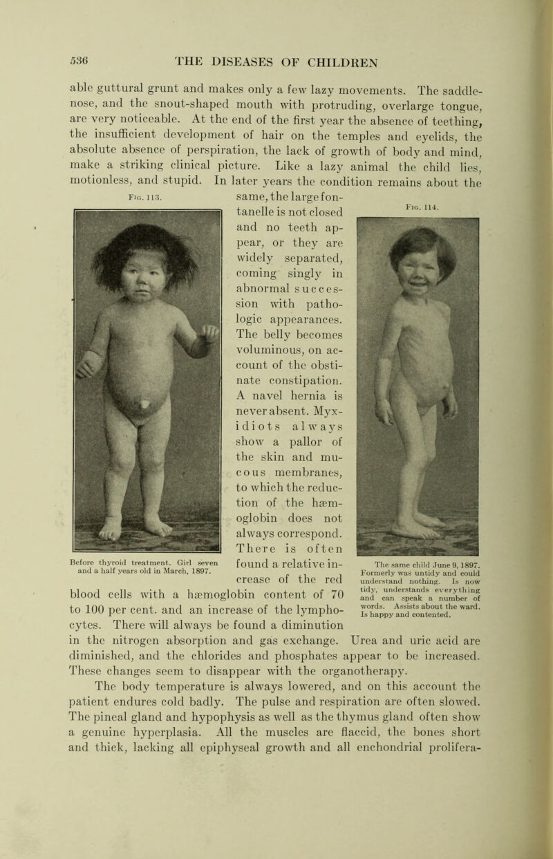 Fig. 114. able guttural grunt and makes only a few lazy movements. The saddle- nose, and the snout-shaped mouth with protruding, overlarge tongue, are very noticeable. At the end of the first year the absence of teething, the insufficient development of hair on the temples and eyelids, the absolute absence of perspiration, the lack of growth of body and mind, make a striking clinical picture. Like a lazy animal the child lies, motionless, and stupid. In later years the condition remains about the fig. ii3. same, the large fon- tanelle is not closed and no teeth ap- pear, or they are widely separated, coming singly in abnormal succes- sion with patho- logic appearances. The belly becomes voluminous, on ac- count of the obsti- nate constipation. A navel hernia is never absent. Myx- idiots always show a pallor of the skin and mu- cous membranes, to which the reduc- tion of the haem- oglobin does not always correspond. There is often found a relative in- crease of the red blood cells with a haemoglobin content of 70 to 100 per cent, and an increase of the lympho- cytes. There will always be found a diminution in the nitrogen absorption and gas exchange. Urea and uric acid are diminished, and the chlorides and phosphates appear to be increased. These changes seem to disappear with the organotherapy. The body temperature is always lowered, and on this account the patient endures cold badly. The pulse and respiration are often slowed. The pineal gland and hypophysis as well as the thymus gland often show a genuine hyperplasia. All the muscles are flaccid, the bones short and thick, lacking all epiphyseal growth and all enchondrial prolifera- Before thyroid treatment. Girl seven and a half years old in March, 1897. The same child June 9, 1897. Formerly was untidy and could understand nothing. Is now tidy, understands everything and can speak a number of words. Assists about the ward. Is happy and contented.