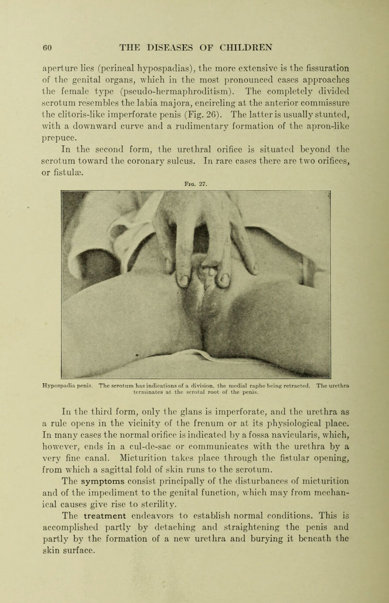 aperture lies (perineal hypospadias), the more extensive is the fissuration of the genital organs, which in the most pronounced cases approaches the female type (pseudo-hermaphroditism). The completely divided scrotum resembles the labia majora, encircling at the anterior commissure the clitoris-like imperforate penis (Fig. 20). The latter is usually stunted, with a downward curve and a rudimentary formation of the apron-like prepuce. In the second form, the urethral orifice is situated beyond the scrotum toward the coronary sulcus. In rare cases there are two orifices, or fistula;. Fig. 27. Hypospadia penis. The scrotum has indications of a division, the medial raphe being retracted. The urethra terminates at the scrotal root of the penis. In the third form, only the glans is imperforate, and the urethra as a rule opens in the vicinity of the frenum or at its physiological place. In many cases the normal orifice is indicated by a fossa navicularis, which, however, ends in a cul-de-sac or communicates with the urethra by a very fine canal. Micturition takes place through the fistular opening, from which a sagittal fold of skin runs to the scrotum. The symptoms consist principally of the disturbances of micturition and of the impediment to the genital function, which may from mechan- ical causes give rise to sterility. The treatment endeavors to establish normal conditions. This is accomplished partly by detaching and straightening the penis and partly by the formation of a new urethra and burying it beneath the skin surface.