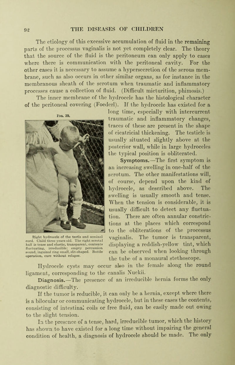 The etiology of this excessive accumulation of fluid in the remaining parts of the processus vaginalis is not yet completely clear. The theory that the source of the fluid is the peritoneum can only apply to cases where there is communication with the peritoneal cavity. For the other cases it is necessary to assume a hypersecretion of the serous mem- brane, such as also occurs in other similar organs, as for instance in the membranous sheath of the scrotum when traumatic and inflammatory processes cause a collection of fluid. (Difficult micturition, phimosis.) The inner membrane of the hydrocele has the histological character of the peritoneal covering (Foederl). If the hydrocele has existed for a long time, especially with intercurrent traumatic and inflammatory changes, traces of these are present in the shape of cicatricial thickening. The testicle is usually situated slightly above at the posterior wall, while in large hydroceles the typical position is obliterated. Symptoms.—The first symptom is an increasing swelling in one-half of the scrotum. The other manifestations will, of course, depend upon the kind of hydrocele, as described above. The swelling is usually smooth and tense. When the tension is considerable, it is usually difficult to detect any fluctua- tion. There are often annular constric- tions at the places which correspond to the obliterations of the processus vaginalis. The tumor is transparent, displaying a reddish-yellow tint, which can be observed when looking through the tube of a monaural stethoscope. Hydrocele cysts may occur also in the female along the round ligament, corresponding to the canalis Nuckii. Diagnosis.—The presence of an irreducible hernia forms the only diagnostic difficulty. If the tumor is reducible, it can only be a hernia, except where there is a bilocular or communicating hydrocele, but in these cases the contents, consisting of intestinal coils or free fluid, can be easily made out owing to the slight tension. In the presence of a tense, hard, irreducible tumor, which the history has shown to have existed for a long time without impairing the general condition of health, a diagnosis of hydrocele should be made. The only Fig. 39. Right hydrocele of the testis and seminal cord. Child three years old. The right scrotal half is tense and elastic, transparent, contents fluctuating, irreducible; empty percussion sound, inguinal ring small, slit-shaped. Bottle operation, cure without relapse.