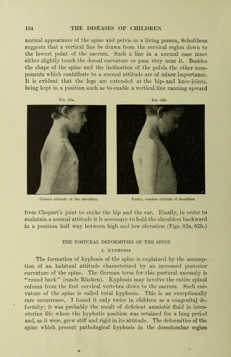 normal appearance of the spine and pelvis in a living person, Schulthess suggests that a vertical line be drawn from the cervical region down to the lowest point of the sacrum. Such a line in a normal case must either slightly touch the dorsal curvature or pass vfery near it. Besides the shape of the spine and the inclination of the pelvis the other com- ponents which contribute to a normal attitude are of minor importance. It is evident that the legs are extended at the hip- and knee-joints, being kept in a position such as to enable a vertical line running upward Fig. 62a. Fig. 62b Correct attitude of the shoulders. Faulty, careless attitude of shoulders. from Chopart’s joint to strike the hip and the ear. Finalty, in order to maintain a normal attitude it is necessary to hold the shoulders backward in a position half way between high and low elevation (Figs. G2a, 62b.) THE POSTURAL DEFORMITIES OF THE SPINE I. KYPHOSIS The formation of kyphosis of the spine is explained by the assump- • tion of an habitual attitude characterized by an increased posterior curvature of the spine. The German term for this postural anomaly is “round back” (runde Riicken). Kyphosis may involve the entire spinal column from the first cervical vertebra down to the sacrum. Such cur- vature of the spine is called total kyphosis. This is an exceptionally rare occurrence. I found it only twice in children as a congenital de- formity; it was probably the result of deficient amniotic fluid in intra- uterine life where the kyphotic position was retained for a long period and, as it were, grew stiff and rigid in its attitude. The deformities of the spine which present pathological kyphosis in the dorsolumbar region