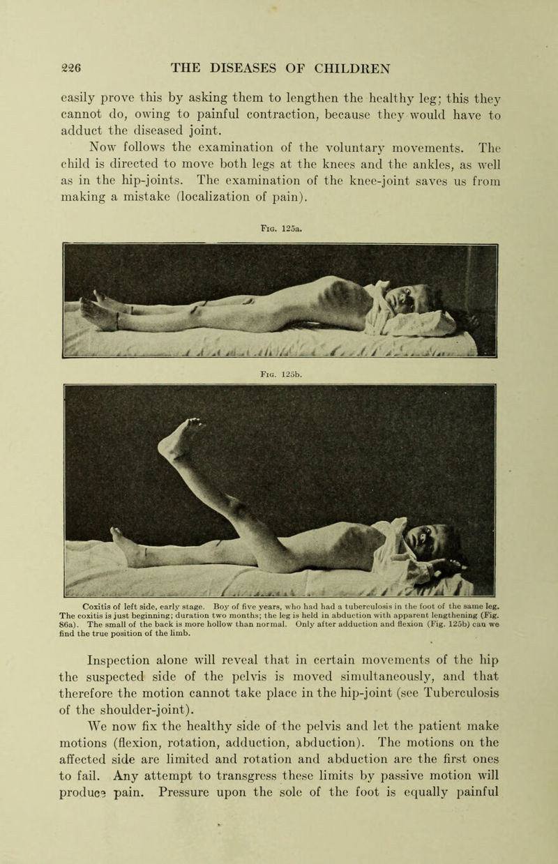 easily prove this by asking them to lengthen the healthy leg; this they cannot do, owing to painful contraction, because they would have to adduct the diseased joint. Now follows the examination of the voluntary movements. The child is directed to move both legs at the knees and the ankles, as well as in the hip-joints. The examination of the knee-joint saves us from making a mistake (localization of pain). Fig. 125a. Coxitis of left side, early stage. Boj^ of five years, who had had a tuberculosis in the foot of the same leg. The coxitis is just beginning; duration two months; the leg is held in abduction with apparent lengthening (Fig. 86a). The small of the back is more hollow than normal. Only after adduction and flexion (Fig. 125b) can we find the true position of the limb. Inspection alone will reveal that in certain movements of the hip the suspected side of the pelvis is moved simultaneously, and that therefore the motion cannot take place in the hip-joint (see Tuberculosis of the shoulder-joint). We now fix the healthy side of the pelvis and let the patient make motions (flexion, rotation, adduction, abduction). The motions on the affected side are limited and rotation and abduction are the first ones to fail. Any attempt to transgress these limits by passive motion will produce pain. Pressure upon the sole of the foot is equally painful