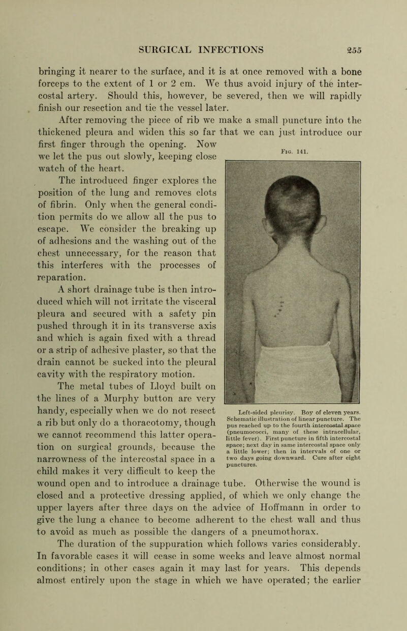 bringing it nearer to the surface, and it is at once removed with a bone forceps to the extent of 1 or 2 cm. We thus avoid injury of the inter- costal artery. Should this, however, be severed, then we will rapidly finish our resection and tie the vessel later. After removing the piece of rib we make a small puncture into the thickened pleura and widen this so far that we can just introduce our first finger through the opening. Now we let the pus out slowly, keeping close watch of the heart. The introduced finger explores the position of the lung and removes clots of fibrin. Only when the general condi- tion permits do we allow all the pus to escape. We consider the breaking up of adhesions and the washing out of the chest unnecessary, for the reason that this interferes with the processes of reparation. A short drainage tube is then intro- duced which will not irritate the visceral pleura and secured with a safety jun pushed through it in its transverse axis and which is again fixed with a thread or a strip of adhesive plaster, so that the drain cannot be sucked into the pleural cavity with the respiratory motion. The metal tubes of Lloyd built on the lines of a Murphy button are very handy, especially when we do not resect a rib but only do a thoracotomy, though we cannot recommend this latter opera- tion on surgical grounds, because the narrowness of the intercostal space in a child makes it very difficult to keep the wound open and to introduce a drainage tube. Otherwise the wound is closed and a protective dressing applied, of which we only change the upper layers after three days on the advice of Hoffmann in order to give the lung a chance to become adherent to the chest wall and thus to avoid as much as possible the dangers of a pneumothorax. The duration of the suppuration which follows varies considerably. In favorable cases it will cease in some weeks and leave almost normal conditions; in other cases again it may last for years. This depends almost entirely upon the stage in which we have operated; the earlier Fig. 141. Left-sided pleurisy. Boy of eleven years. Schematic illustration of linear puncture. The pus reached up to the fourth intercostal space (pneumococci, many of these intracellular, little fever). First puncture in fifth intercostal space; next day in same intercostal space only a little lower; then in intervals of one or two days going downward. Cure after eight punctures.