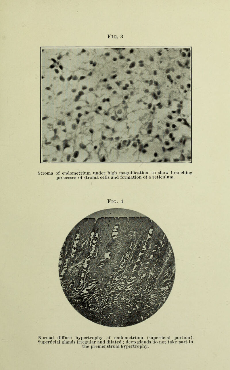 Stroma of endometrium under high magnification to show branching processes of stroma cells and formation of a reticulum. Fig. 4 Normal diffuse hypertrophy of endometrium (superficial portion) Superficial glands irregular and dilated ; deep glands do not take part in the premenstrual hypertrophy. l life