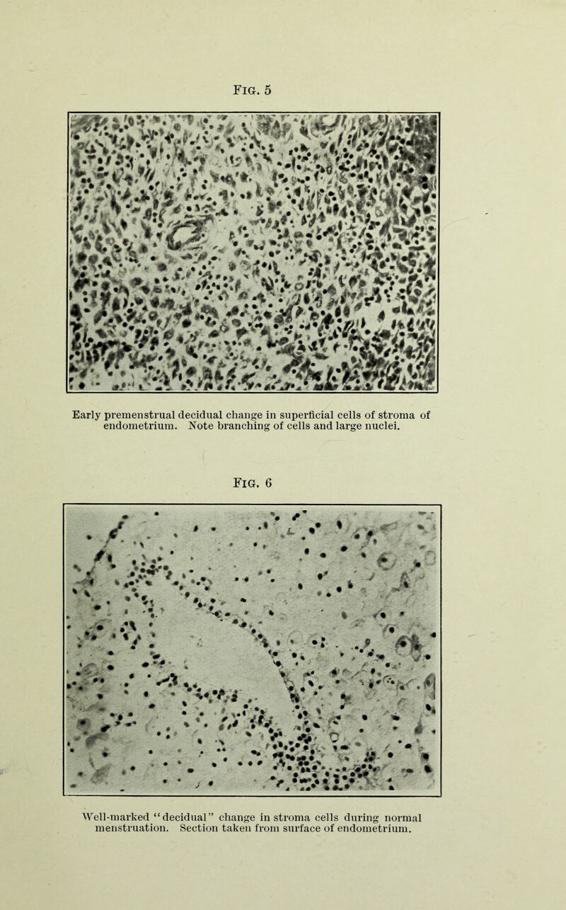 Early premenstrual decidual change in superficial cells of stroma of endometrium. Note branching of cells and large nuclei. Fig. 6 Well-marked “decidual” change in stroma cells during normal menstruation. Section taken from surface of endometrium.