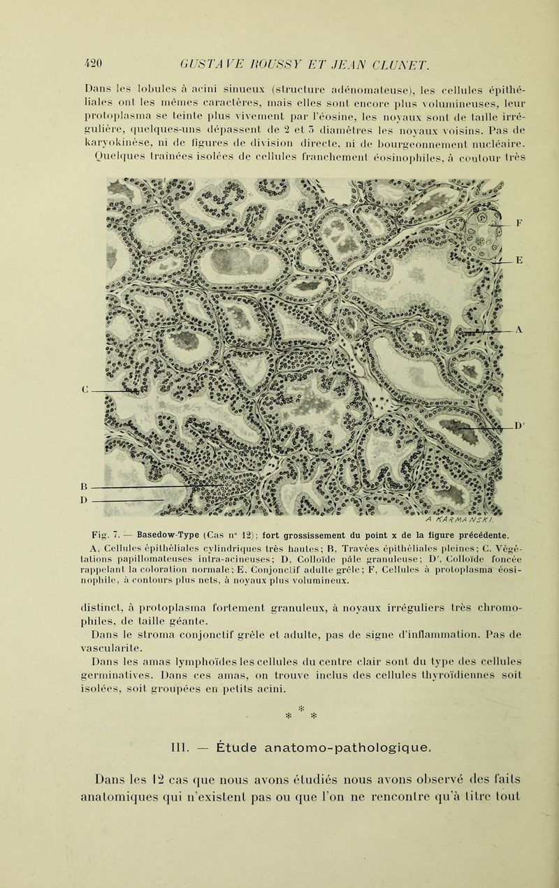 Dans les lobules a acini sinueux (structure adenomateuse), les cellules epithe- liales ont les meraes caracteres, mais elles sont encore plus volumineuses, leur protoplasma se teinte plus vivement par l’eosine, les noyaux sont de taille irre- guliere, quelques-uns depassent de 2 et 3 diametres les noyaux voisins. Pas de karyokinese, ni de figures de division directe, ni de bourgeonnement nucleaire. Quelques trainees isolees de cellules franchement eosinophiles, a contour tres Fig. 7. — Basedow-Type (Cas n° 12); fort grossissement du point x de la figure precedente. A, Cellules epitheliales cylindriques tres hautes; B, Travees epitheliales pleines; C. Vege- tations papillomateuses intra-acineuses; D, Golloide pale granuleuse; D', Colloide foncee rappelant la coloration normale;E, Conjonclif adultegrele; F, Cellules a protoplasma eosi- nophile, a contours plus nets, a noyaux plus volumineux. distinct, a protoplasma fortement granuleux, a noyaux irreguliers tres chromo- philes, de taille geante. Dans le stroma conjonctif grele et adulte, pas de signe d’inflammation. Pas de vascularite. Dans les amas lymphoTdes les cellules du centre clair sont du type des cellules germinatives. Dans ces amas, on trouve inclus des cellules thyroidiennes soit isolees, soit groupees en petits acini. * * III. — Etude anatomo-pathologique. Dans les 12 cas que nous avons etudies nous avons observe des faits anatomiques qui n’existenl pas ou que Ton ne rencontre qu’a litre tout