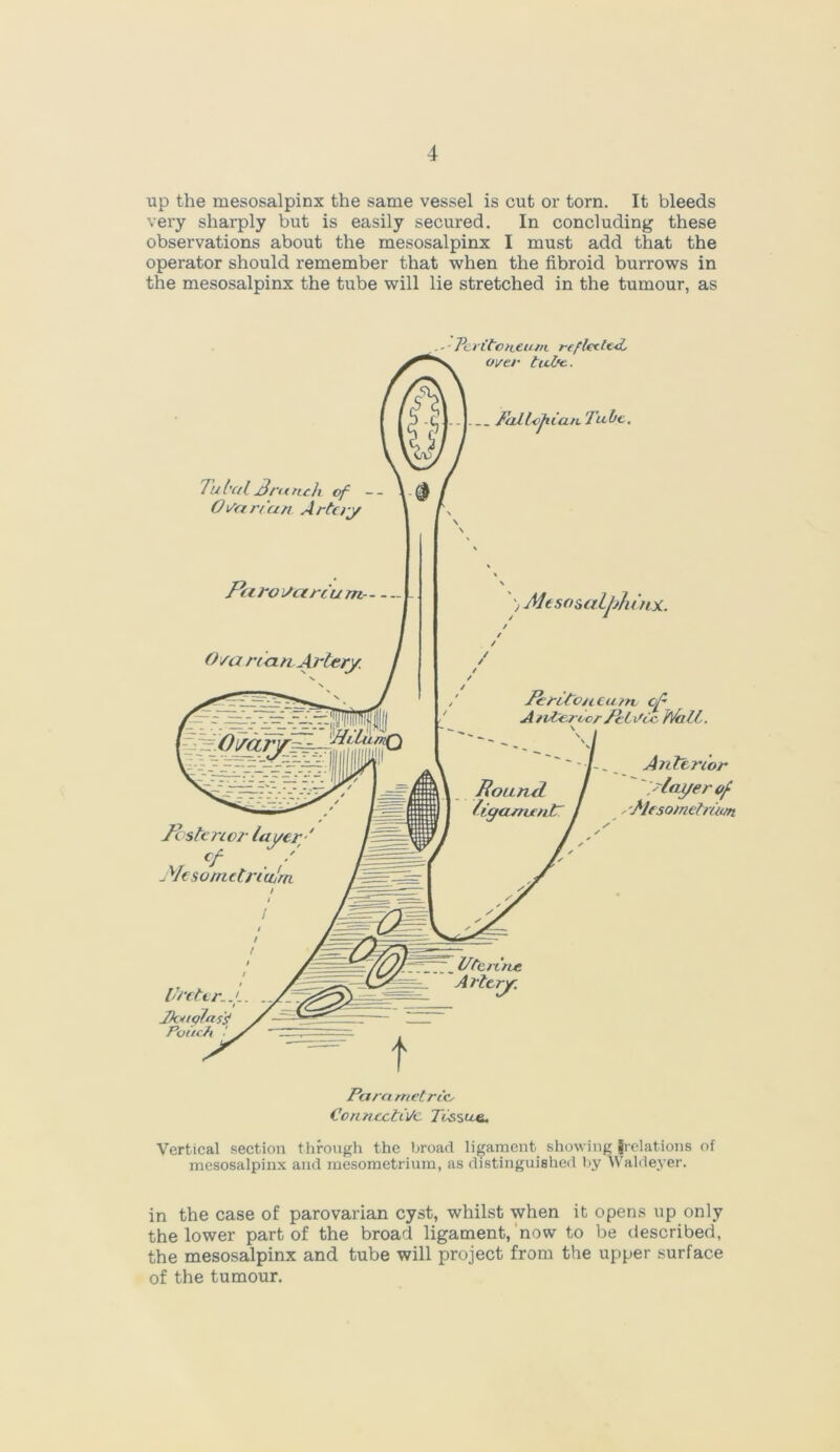 up the mesosalpinx the same vessel is cut or torn. It bleeds very sharply but is easily secured. In concluding these observations about the mesosalpinx I must add that the operator should remember that when the fibroid burrows in the mesosalpinx the tube will lie stretched in the tumour, as Para metric Connective Tissue. Vertical section through the broad ligament, showing Relations of mesosalpinx and mesometrium, as distinguished by Waldeyer. in the case of parovarian cyst, whilst when it opens up only the lower part of the broad ligament, now to be described, the mesosalpinx and tube will project from the upper surface of the tumour.