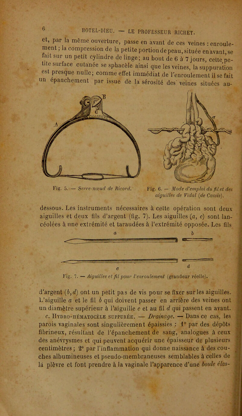 et, par la même ouverture, passe en avant de ces veines : enroule- ment ; la compression de la petite portion de peau, située en avant, se ait sur un petit cylindre de linge; au bout de 6 à 7 jours, cette pe- tite surface cutanée se sphacèle ainsi que les veines, la suppuration est presque nulle; comme effet immédiat de l'enroulement il se fait un epanchement par issue de la sérosité des' veines situées au- Fig. 5. — Serre-Jiœud de Ricord. Fig. 6. — Mode d’emploi du filet des aiguilles de Vidal {de Cassis). dessous. Les instruments nécessaires à celte opération sont deux aiguilles et deux fils d’argent (fig. 7). Les aiguilles (n, c) sont lan- céolées à une extrémité et taraudées à l’extrémité opposée. Les fils a b Fig. 7. — Aiguilles et fit pour l’enroulement (grandeur réelle). d’argent (b, d) ont un petit pas de vis pour se fixer sur les aiguilles. L’aiguille a et le fil b qui doivent passer en arrière des veines ont un diamètre supérieur à l’aiguille c et au fil d qui passent en avant. c. HïDRo-nÉMATOCÈLE suppurée. — Drainage. — Dans ce cas, les parois vaginales sont singulièrement épaissies : 1° par des dépôts fibrineux, résultant de l’épanchement de sang, analogues à ceux des anévrysmes et qui peuvent acquérir une épaisseur de plusieurs centimètres ; 2° par l’inflammation qui donne naissance à des cou- ches albumineuses et pseudo-membraneuses semblables à celles de la plèvre et font prendre à la vaginale l’apparence d’une boule élas-