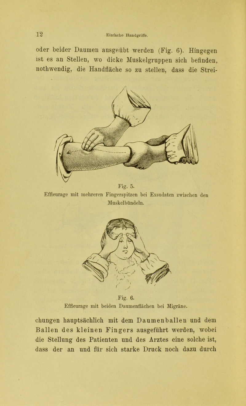 oder beider Daumen ausgeübt werden (Fig. 6). Hingegen ist es an Stellen, wo dicke Muskelgruppen sich befinden, nothwendig, die Handfläche so zu stellen, dass die Strei- Effleurage mit mehreren Fingerspitzen bei Exsudaten zwischen den Muskelbündeln. Fig. 6. Effleurage mit beiden Daumenflächen bei Migräne. chungen hauptsächlich mit dem Daumen ballen und dem Ballen des kleinen Fingers ausgeführt werden, wobei die Stellung des Patienten und des Arztes eine solche ist, dass der an und für sich starke Druck noch dazu durch