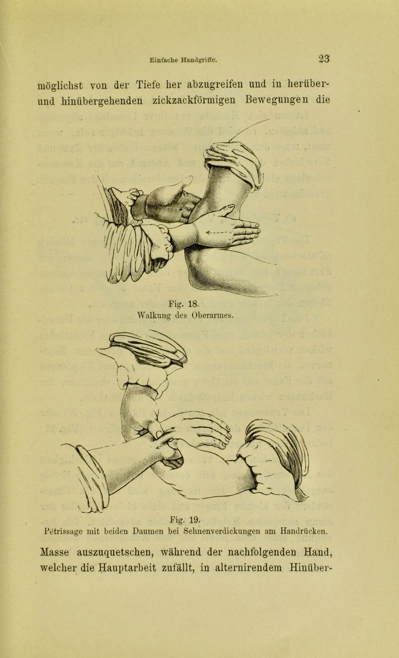 möglichst von der Tiefe her abzugreifen und in heriiber- und hiniibergehenden zickzackförmigen Bewegungen die Walkung des Oberarmes. Fig. 19. Petrissage mit beiden Daumen bei Sehnenverdickungen am Handrücken. Masse auszuquetschen, während der nachfolgenden Hand, welcher die Hauptarbeit zufällt, in alternirendem Hinüber-