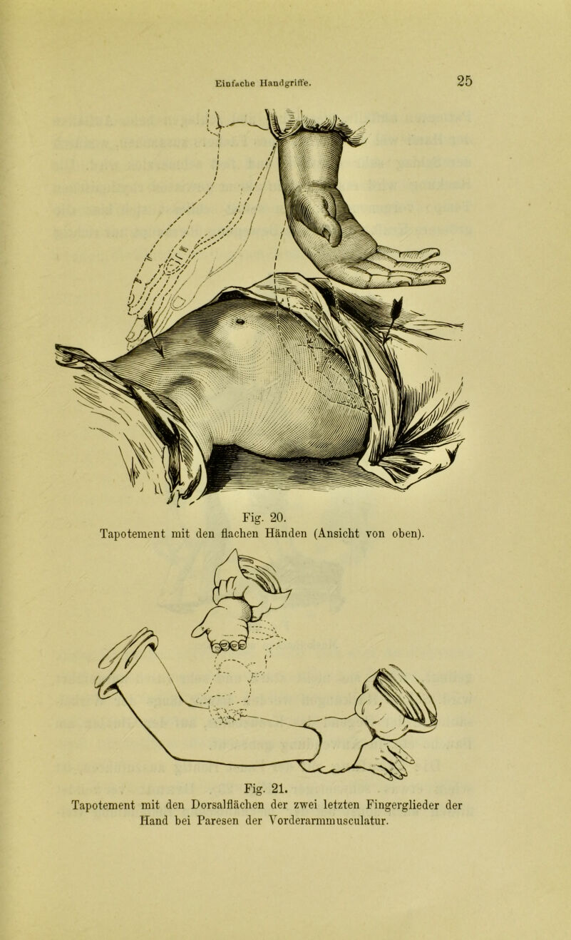 Fig. 20. Tapotement mit den flachen Händen (Ansicht von oben). Tapotement mit den Dorsalflächen der zwei letzten Fingerglieder der Hand bei Paresen der Vorderarmmusculatur.