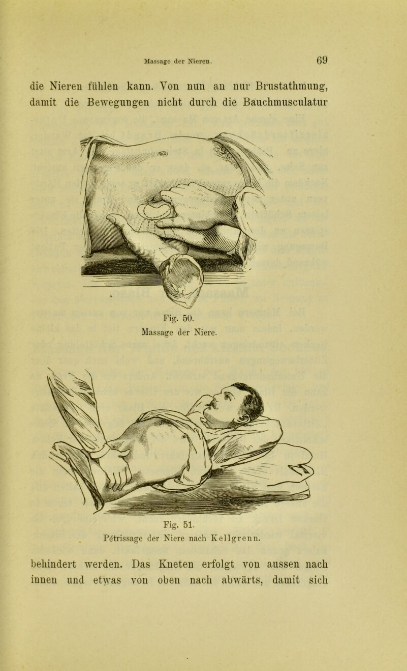 die Nieren fühlen kann. Von nun an nur Brustathmung, damit die Bewegungen nicht durch die Bauchmusculatur Fier. 50. Massage der Niere. Fig. 51. Pdtrissage der Niere nach Kellgrenn. behindert werden. Das Kneten erfolgt von aussen nach innen und etwas von oben nach abwärts, damit sich