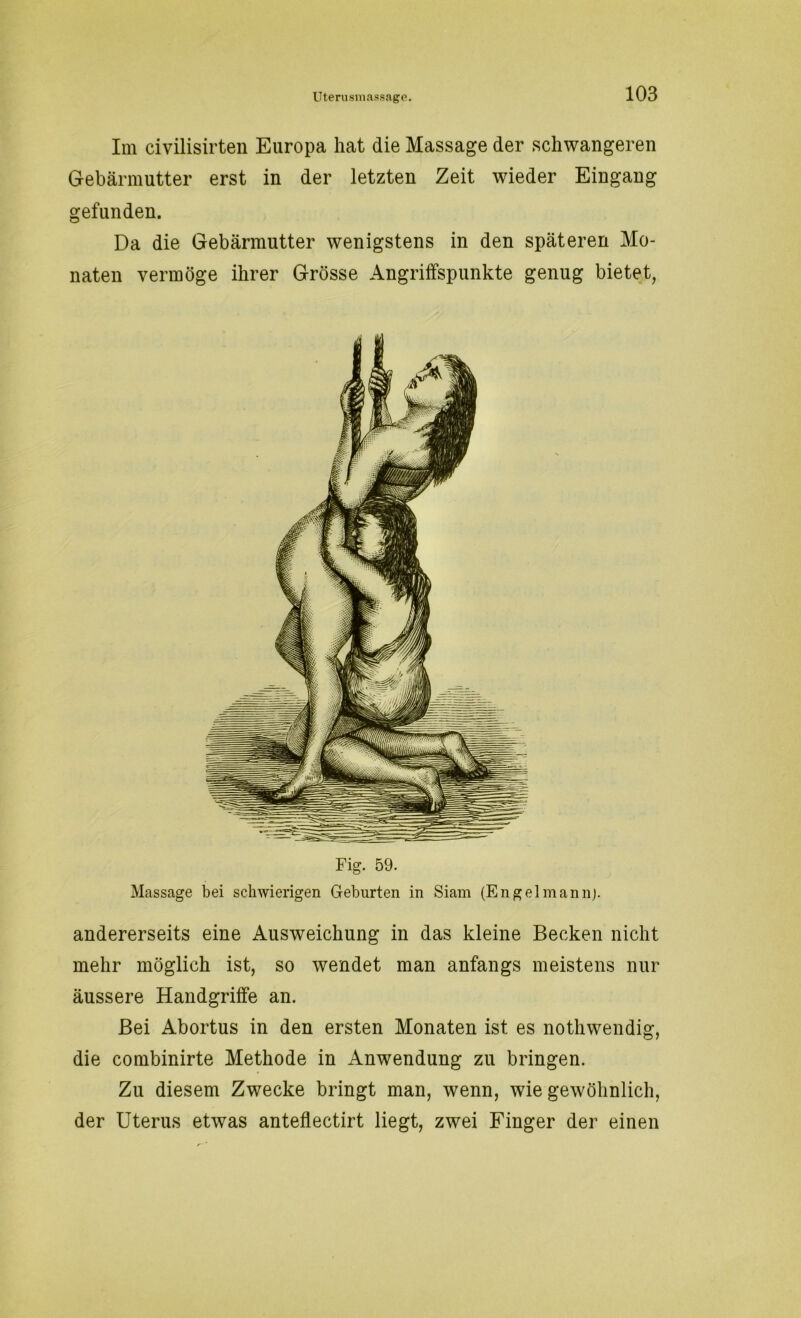 Im civilisirten Europa hat die Massage der schwangeren Gebärmutter erst in der letzten Zeit wieder Eingang gefunden. Da die Gebärmutter wenigstens in den späteren Mo- naten vermöge ihrer Grösse Angriffspunkte genug bietet, Fig. 59. Massage bei schwierigen Geburten in Siam (Engelmannj. andererseits eine Ausweichung in das kleine Becken nicht mehr möglich ist, so wendet man anfangs meistens nur äussere Handgriffe an. Bei Abortus in den ersten Monaten ist es nothwendig, die combinirte Methode in Anwendung zu bringen. Zu diesem Zwecke bringt man, wenn, wie gewöhnlich, der Uterus etwas anteflectirt liegt, zwei Finger der einen