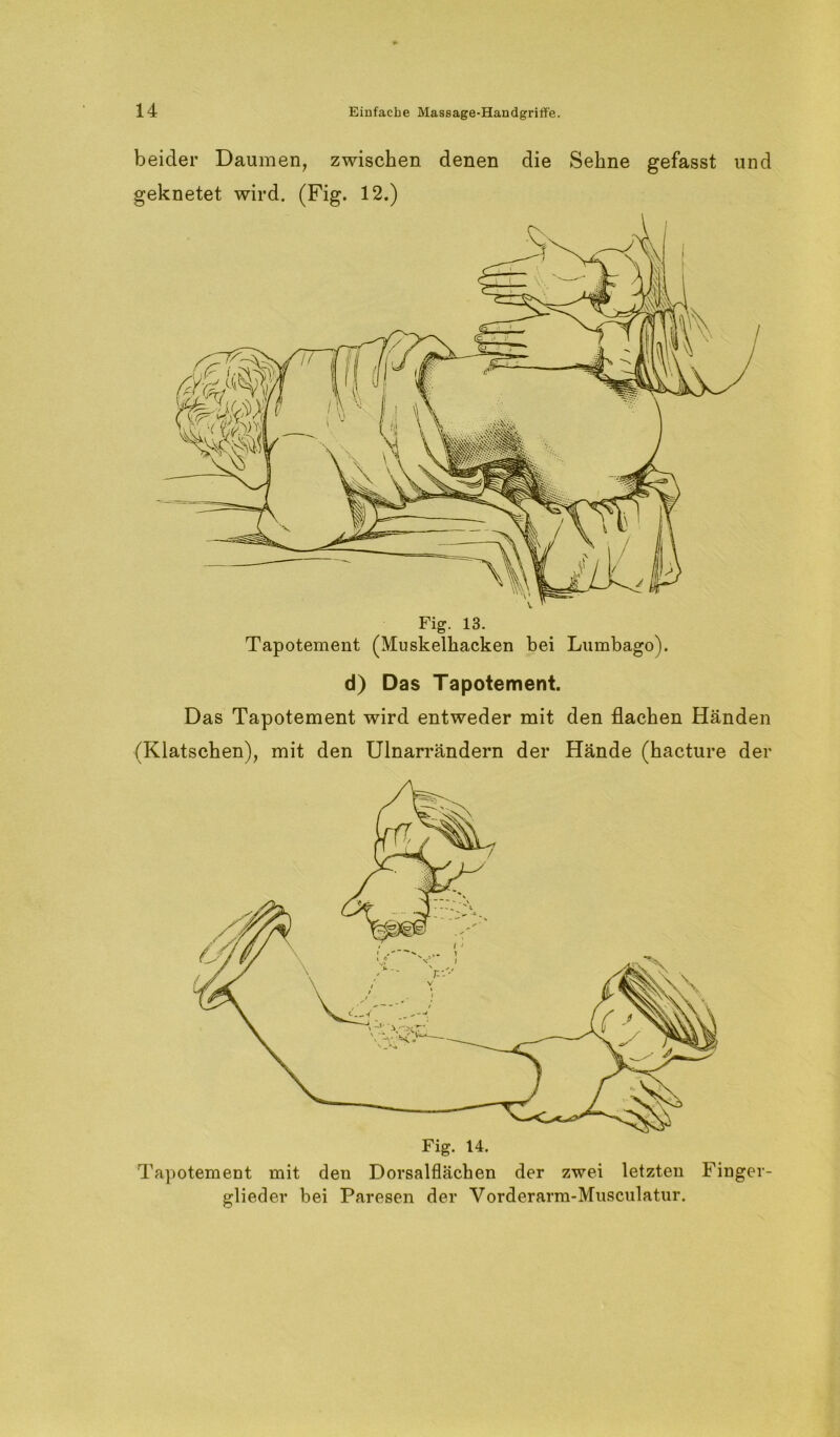 beider Daumen, zwischen denen die Sehne gefasst und geknetet wird. (Fig. 12.) Fig. 13. Tapotement (Muskelhacken bei Lumbago). d) Das Tapotement. Das Tapotement wird entweder mit den flachen Händen (Klatschen), mit den Ulnarrändern der Hände (hacture der Fig. 14. Tapotement mit den Dorsalflächen der zwei letzten Finger- glieder bei Paresen der Vorderarm-Musculatur.