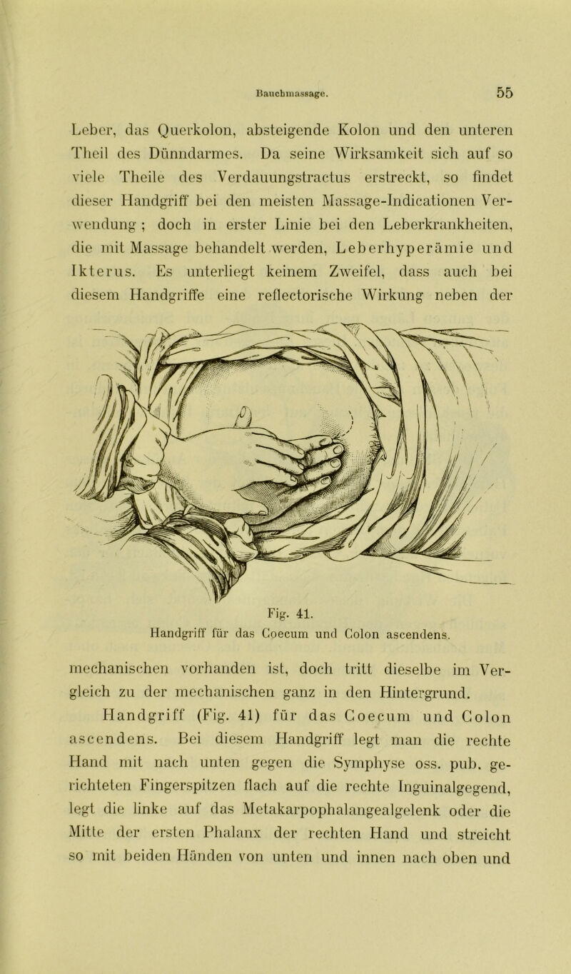 Leber, das Querkolon, absteigende Kolon und den unteren Theil des Dünndarmes. Da seine Wirksamkeit sich auf so viele Theile des Verdauungstractus erstreckt, so findet dieser Handgriff bei den meisten Massage-Indicationen Ver- wendung ; doch in erster Linie bei den Leberkrankheiten, die mit Massage behandelt werden, Leberhyperämie und Ikterus. Es unterliegt keinem Zweifel, dass auch bei diesem Handgriffe eine reflectorische Wirkung neben der Fig. 41. Handgriff für das Goecum und Colon ascendens. mechanischen vorhanden ist, doch tritt dieselbe im Ver- gleich zu der mechanischen ganz in den Hintergrund. Handgriff (Fig. 41) für das Goecum und Colon ascendens. Bei diesem Handgriff legt man die rechte Hand mit nach unten gegen die Symphyse oss. pub. ge- richteten Fingerspitzen flach auf die rechte Inguinalgegend, legt die linke auf das Metakarpophalangealgelenk oder die Mitte der ersten Phalanx der rechten Pland und streicht so mit beiden Händen von unten und innen nach oben und