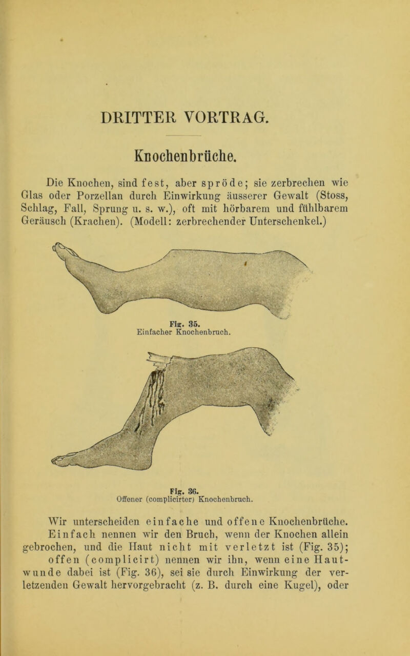 DRITTER VORTRAG. Knochenb rtlclie. Die Knochen, sind fest, aber spröde; sie zerbrechen wie Glas oder Porzellan durch Einwirkung äusserer Gewalt (Stoss, Schlag, Fall, Sprung u. s. w.), oft mit hörbarem und fühlbarem Geräusch (Krachen). (Modell: zerbrechender Unterschenkel.) Fle. 35. Einfacher Knochenbruch. Fig. 3G. Offener (complicirter) Knochenbruch. Wir unterscheiden einfache und offene Knochenbrüche. Einfach nennen wir den Bruch, wenn der Knochen allein gebrochen, und die Haut nicht mit verletzt ist (Fig. 35); offen (complicirt) nennen wir ihn, wenn eine Haut- wunde dabei ist (Fig. 36), sei sie durch Einwirkung der ver- letzenden Gewalt hervorgebracht (z. B. durch eine Kugel), oder