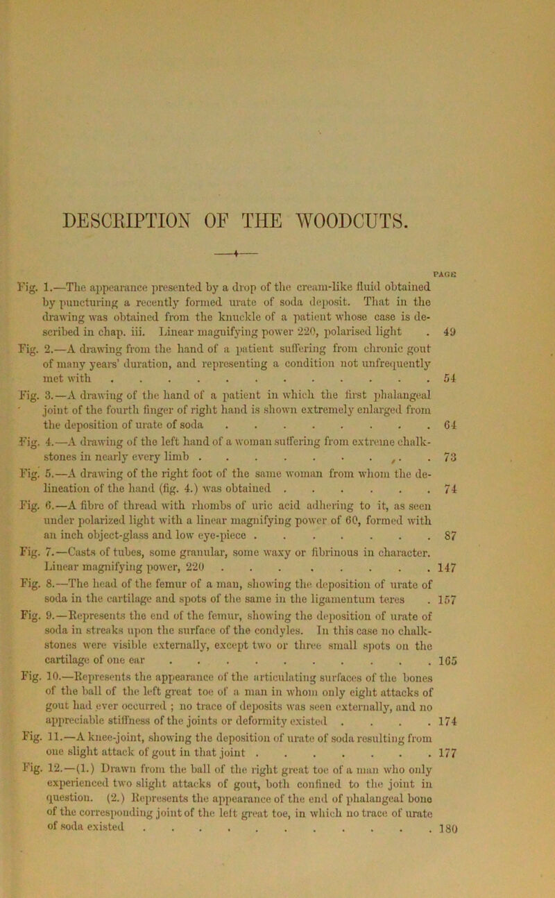 DESCRIPTION OF THE WOODCUTS. PAGE rig. 1.—Tlie appeaniiice presented by a drop of tlie cn^ani-like fluid obtained by puncturing a recently formed umtc of soda deposit. That in the drawing was obtained from the knuckle of a patient whose case is de- scribed in chap. iii. Linear magnifying power •i'iO, polarised light . 49 Fig. 2.—A drawing from the hand of a patient suffering from chronic gout of many years’ duration, and representing a condition not unfrequcntly met with ............ 54 Fig. 3.—A drawing of the hand of a patient in whicli the first phalangeal joint of the fourth finger of right hand is shown extremely enlarged from the deposition of urate of soda 64 Fig. 4.—A drawing of the left hand of a woman .suffering from extreme chalk- stones in nearly every limb . . . . . . • t- .73 Fig. 5.—A drawing of the right foot of the same womim from whom the de- lineation of tlie hand (fig. 4.) was obtained 74 Fig. 6.—A fibre of thread with rhombs of uric acid adhering to it, as seen under polarized light with a linear magnifying power of 60, formed with an inch object-gla.ss and low eye-piece 87 Fig. 7.—Casts of tubes, some granular, some waxy or fibrinous in character. Linear magnifying power, 220 147 Fig. 8.—The head of the femur of a man, showing the dijposition of urate of soda in the cartilage and spots of the same in the ligamentum teres . 157 Fig. 9.—Repre.sents the end of the femur, .showing the deposition of urate of soda ill streaks ujion the surface of the condyles. In this case no chalk- stones were visible extenially, except two or three small spots on the cartilage of one ear 165 Fig. 10.—Represents the appearance of the articulating surfaces of the bones of the ball of the left great toe of a man in whom only eight attacks of gout had ever occurred ; no trace of dejiosits was seen externally, and no appreciable stifliiess of the joints or deformity existed . . . .174 Fig. 11.—A knee-joint, showing the deposition of urate of soda resulting from one slight attack of gout in that joint 177 Fig. 12.—(1.) Drawn from the ball of the right great toe of a inuii who only experienced two slight attacks of gout, both confined to the joint in question. (2.) Represents the appearance of the end of phalangeal bone of the correspouding joint of the lelt gi’cat toe, in which no trace of urate of soda existed 180