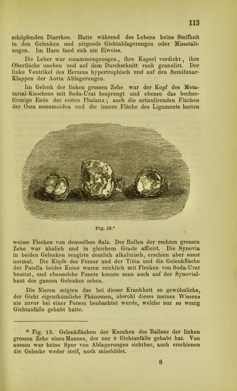 schöpfenden Diarrhoe. Hatte während des Lebens keine Steifheit in den Gelenken und nirgends Gichtablagerungen oder Missstalt- ungen. Im Harn fand sich nie Eiweiss. Die Leber war zAisammengezogen, ihre Kapsel verdickt, ihre Oberfläche uneben und auf dem Durchschnitt rauh granulirt. Der linke Ventrikel des Herzens hypertrophisch und auf den Semilunar- Klappen der Aorta Ablagerungen. Im Gelenk der linken grossen Zehe war der Kopf des Meta- tarsal-Knochens mit Soda-Urat besprengt und ebenso das becher- förmige Ende der ersten Phalanx • auch die articulirenden Flächen der Ossa sessamoidea und die innere Fläche des Ligaments hatten Fig. 13.* weisse Flecken von demselben Salz. Der Ballen der rechten grossen Zehe war ähnlich und in gleichem Grade afficirt. Die Synovia in beiden Gelenken reagirte deutlich alkalinisch, erschien aber sonst normal. Die Köpfe des Femur und der Tibia und die Gelenkfläche der Patella beider Kniee waren reichlich mit Flecken von Soda-Urat besetzt, und ebensolche Puncte konnte man auch auf der Synovial- haut des ganzen Gelenkes sehen. Die Nieren zeigten das bei dieser Krankheit so gewöhnliche, der Gicht eigenthümliche Phänomen, obwohl dieses meines Wissens nie zuvor bei einer Person beobachtet wurde, welche nur so wenig Gichtanfälle gehabt hatte. * Fig. 1.3. Gelenkflächen der Knochen des Ballens der linken grossen Zehe eines Mannes, der nur 8 Gichtanfälle gehabt hat. Von aussen war keine Spur von Ablagerungen sichtbar, auch erschienen die Gelenke weder steif, noch missbildet. 8