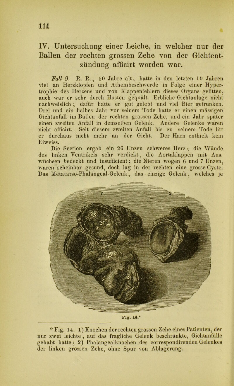 IV. Untersuchung einer Leiche, in welcher nur der Ballen der rechten grossen Zehe von der Gichtent- zündung afficirt worden war. Fall 9. R. R., 50 Jahre alt, hatte in den letzten 10 Jahren viel an Herzklopfen und Athembeschwerde in Folge einer Hyper- trophie des Herzens und von Klappenfehlern dieses Organs gelitten, auch war er sehr durch Husten gequält. Erbliche Gichtanlage nicht nachweislich ^ dafür hatte er gut gelebt und viel Bier getrunken. Drei und ein halbes Jahr vor seinem Tode hatte er einen massigen Gichtanfall im Ballen der rechten grossen Zehe, und ein Jahr später einen zweiten Anfall in demselben Gelenk. Andere Gelenke waren nicht afficirt. Seit diesem zweiten Anfall bis zu seinem Tode litt er durchaus nicht mehr an der Gicht. Der Harn enthielt kein Eiweiss. Die Section ergab ein 26 Unzen schweres Herz ; die Wände des linken Ventrikels sehr verdickt, die Aortaklappen mit Aus. wüchsen bedeckt und insufficient ^ die Nieren wogen 6 und 7 Unzen, waren scheinbar gesund, doch lag in der rechten eine grosse Cyste. Das Metatarso-Phalangeal-Gelenk, das einzige Gelenk, welches je Fig. 14.* Fig. 14. 1) Knochen der rechten grossen Zehe eines Patienten, der nur zwei leichte , auf das fragliche Gelenk beschränkte, Gichtanfälle gehabt hatte \ 2) Phalangealknochen des correspondirendeii Gelenkes der linken grossen Zehe, ohne Spur von Ablagerung.