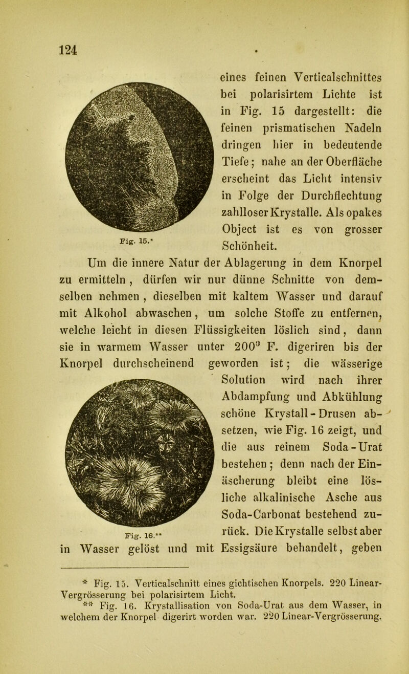 Fig. IS.’ eines feinen Verticalschnittes bei polarisirtem Lichte ist in Fig. 15 dargestellt: die feinen prismatischen Nadeln dringen hier in bedeutende Tiefe; nahe an der Oberfläche erscheint das Licht intensiv in Folge der Durchflechtung zahlloser Krystalle. Als opakes Object ist es von grosser Schönheit. Um die innere Natur der Ablagerung in dem Knorpel zu ermitteln , dürfen wir nur dünne Schnitte von dem- selben nehmen , dieselben mit kaltem Wasser und darauf mit Alkohol abwaschen, um solche Stoffe zu entfernen, welche leicht in diesen Flüssigkeiten löslich sind, dann sie in warmem Wasser unter 200'^ F. digeriren bis der Knorpel durchscheinend geworden ist; die wässerige Solution wird nach ihrer Abdampfung und Abkühlung schöne Krvstall - Drusen ab- •/ setzen, wie Fig. 16 zeigt, und die aus reinem Soda-Urat bestehen ; denn nach der Ein- äscherung bleibt eine lös- liche alkalinische Asche aus Soda-Carbonat bestehend zu- pjg 16.. rück. Die Krystalle selbst aber in Wasser gelöst und mit Essigsäure behandelt, geben * Fig. 15. Verticalsclinitt eines gichtischen Knorpels. 220 Linear- Vergrösserung bei polarisirtem Licht. Fig. 16. Krystallisation von Socla-Urat aus dem Wasser, in welchem der Knorpel digerirt worden war. 220 Linear-Vergrösserung.