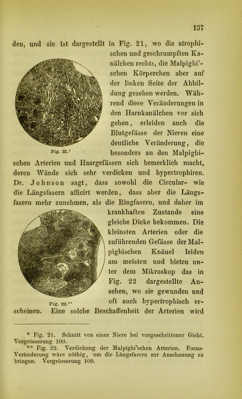 den, und sie ist dcirgestellt in Fig. 21, wo die atrophi- schen und geschrumpften Ka- nälchen rechts, die Malpighi’- schen Körperchen aber auf der linken Seite der Abbil- dung gesehen werden. Wäh- rend diese Veränderungen in den Harnkanälchen vor sich gehen, erleiden auch die Blutgefässe der Nieren eine deutliche Veränderung, die besonders an den Malpighi- schen Arterien und Haargefässen sich bemerklich macht, deren Wände sich sehr verdicken und hypertrophiren. Dr. Johnson sagt, dass sowohl die Circular- wie die Längsfasern afficirt werden, dass aber die Längs- fasern mehr zunehmen, als die Ringfasern, und daher im krankhaften Zustande eine gleiche Dicke bekommen. Die kleinsten Arterien oder die zuführenden Gefässe der Mal- pighischen Knäuel leiden am meisten und bieten un- ter dem Mikroskop das in Fig. 22 dargestellte An- sehen, wo sie gewunden und oft auch hypertrophisch er- scheinen. Eine solche Beschaffenheit der Arterien wird ^ Fig. 21. Schnitt von einer Niere bei A^orgeschrittener Gicht. Vergrösserung 100. ** Fig. 22. Verdickung der Malpighi’schen Arterien. Focus- Veränderung wäre nöthig, um die Längsfasern zur Anschauung zu bringen. Vergrösserung 100.
