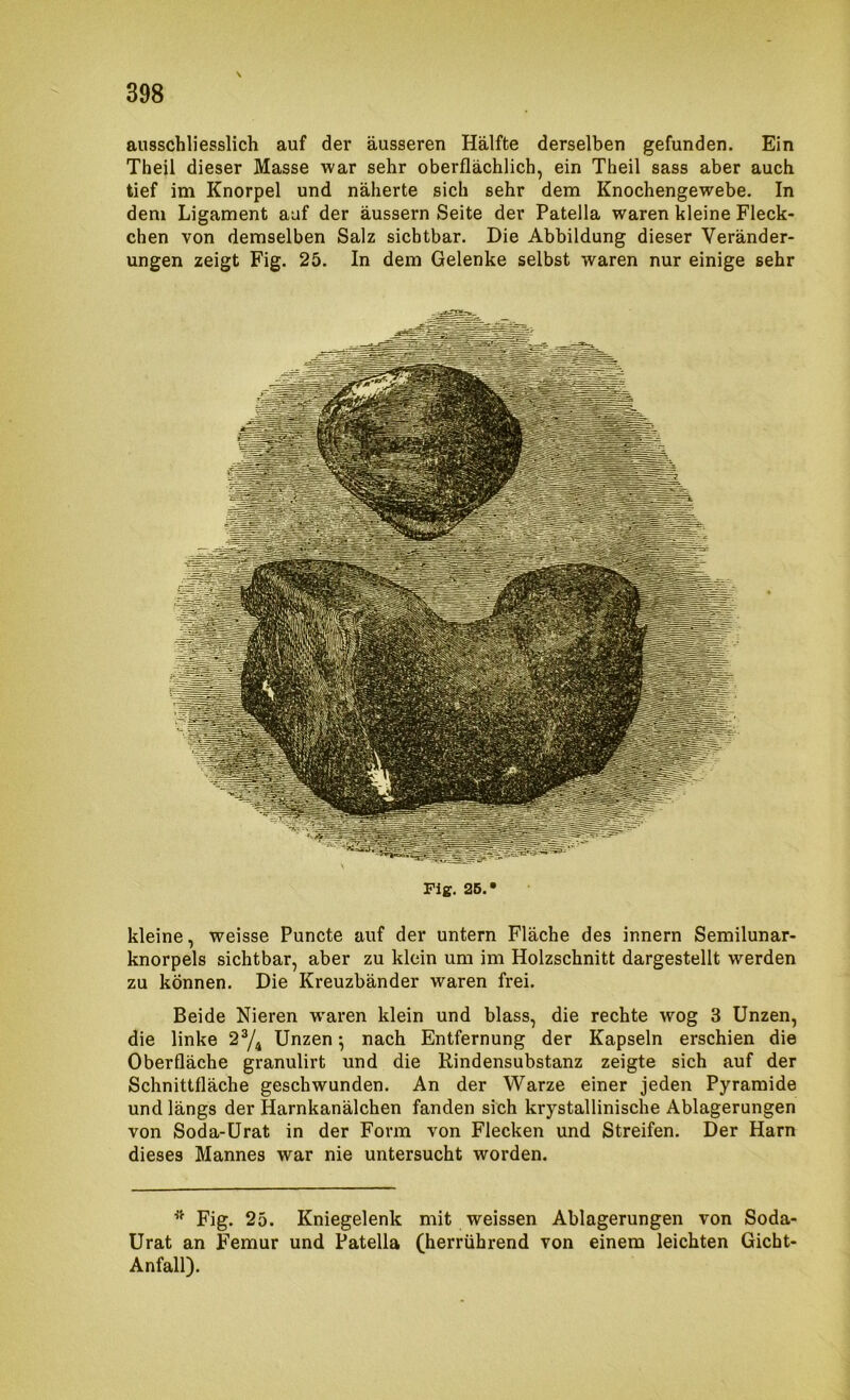 ausschliesslich auf der äusseren Hälfte derselben gefunden. Ein Theil dieser Masse war sehr oberflächlich, ein Theil sass aber auch tief im Knorpel und näherte sich sehr dem Knochengewebe, In dem Ligament auf der äussern Seite der Patella waren kleine Fleck- chen von demselben Salz sichtbar. Die Abbildung dieser Veränder- ungen zeigt Fig. 25. In dem Gelenke selbst waren nur einige sehr kleine, weisse Puncte auf der untern Fläche des Innern Semilunar- knorpels sichtbar, aber zu klein um im Holzschnitt dargestellt werden zu können. Die Kreuzbänder waren frei. Beide Nieren w'aren klein und blass, die rechte wog 3 Unzen, die linke 2^^ Unzen ^ nach Entfernung der Kapseln erschien die Oberfläche granulirt und die Rindensubstanz zeigte sich auf der Schnittfläche geschwunden. An der Warze einer jeden Pyramide und längs der Harnkanälchen fanden sich krystallinische Ablagerungen von Soda-Urat in der Form von Flecken und Streifen, Der Harn dieses Mannes war nie untersucht worden. Fig. 25. Kniegelenk mit weissen Ablagerungen von Soda- Urat an Femur und Patella (herrührend von einem leichten Gicht- Anfall).