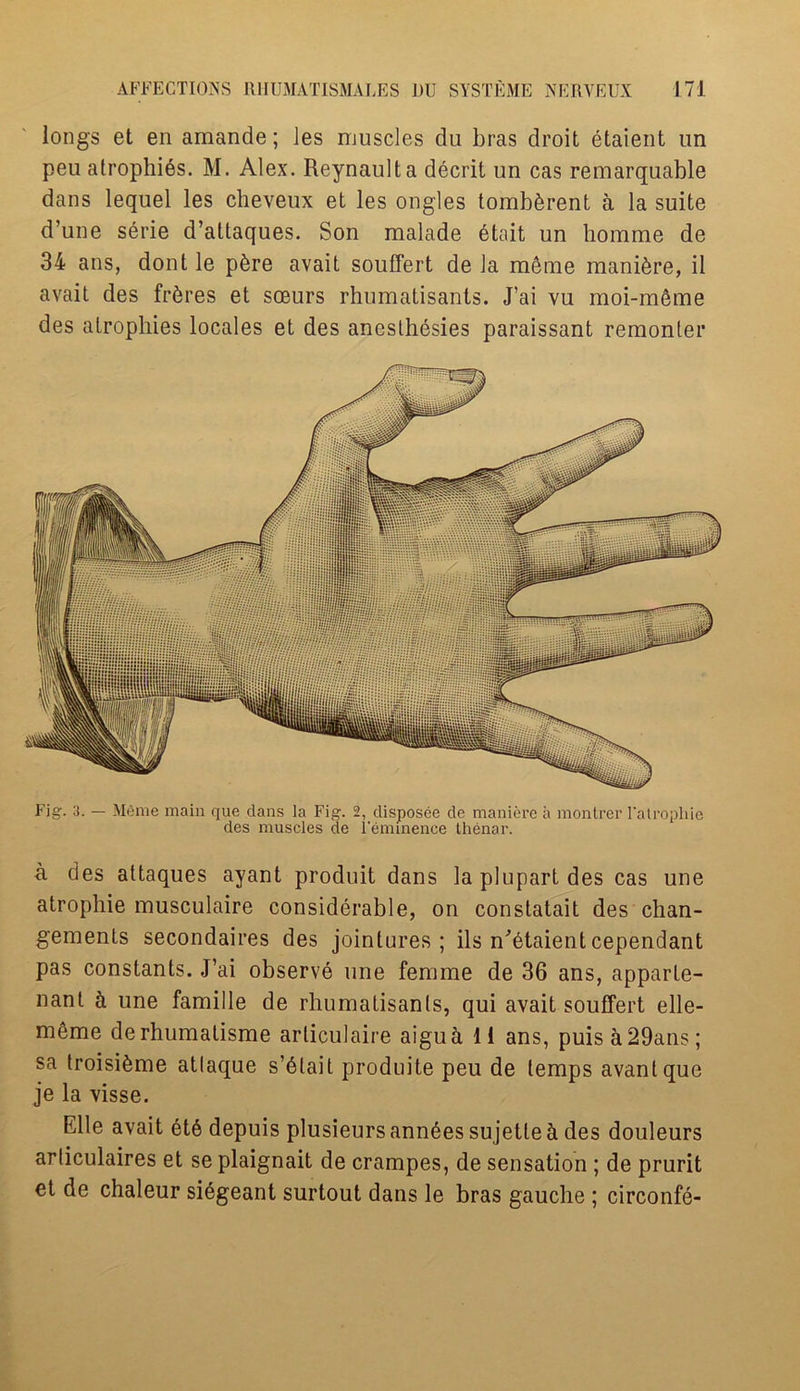 longs et en amande; les muscles du bras droit etaient un peu atrophies. M. Alex. Reynaulta decrit un cas remarquable dans lequel les cheveux et les ongles tomb^rent a la suite d’une serie d’attaques. Son malade etait un homme de 34 ans, dont le p6re avait souffert de la menie manure, il avait des fibres et soeurs rhumatisants. J’ai vu moi-m6me des atrophies locales et des anesthesies paraissant remonler a des attaques ayant produit dans la plupart des cas une atrophie musculaire considerable, on constatait des chan- gements secondaires des jointures; ils n^taientcependant pas constants. J’ai observe une femme de 36 ans, apparte- nant h une famille de rhumatisants, qui avait souffert elle- meme derhumatisme arliculaire aiguh 11 ans, puisa29ans; sa troisi&me atlaque s’dtait produite peu de temps avanlque je la visse. Elle avait et6 depuis plusieurs ann6es sujette & des douleurs arliculaires et se plaignait de crampes, de sensation ; de prurit et de chaleur siegeant surtout dans le bras gauche ; circonfe-