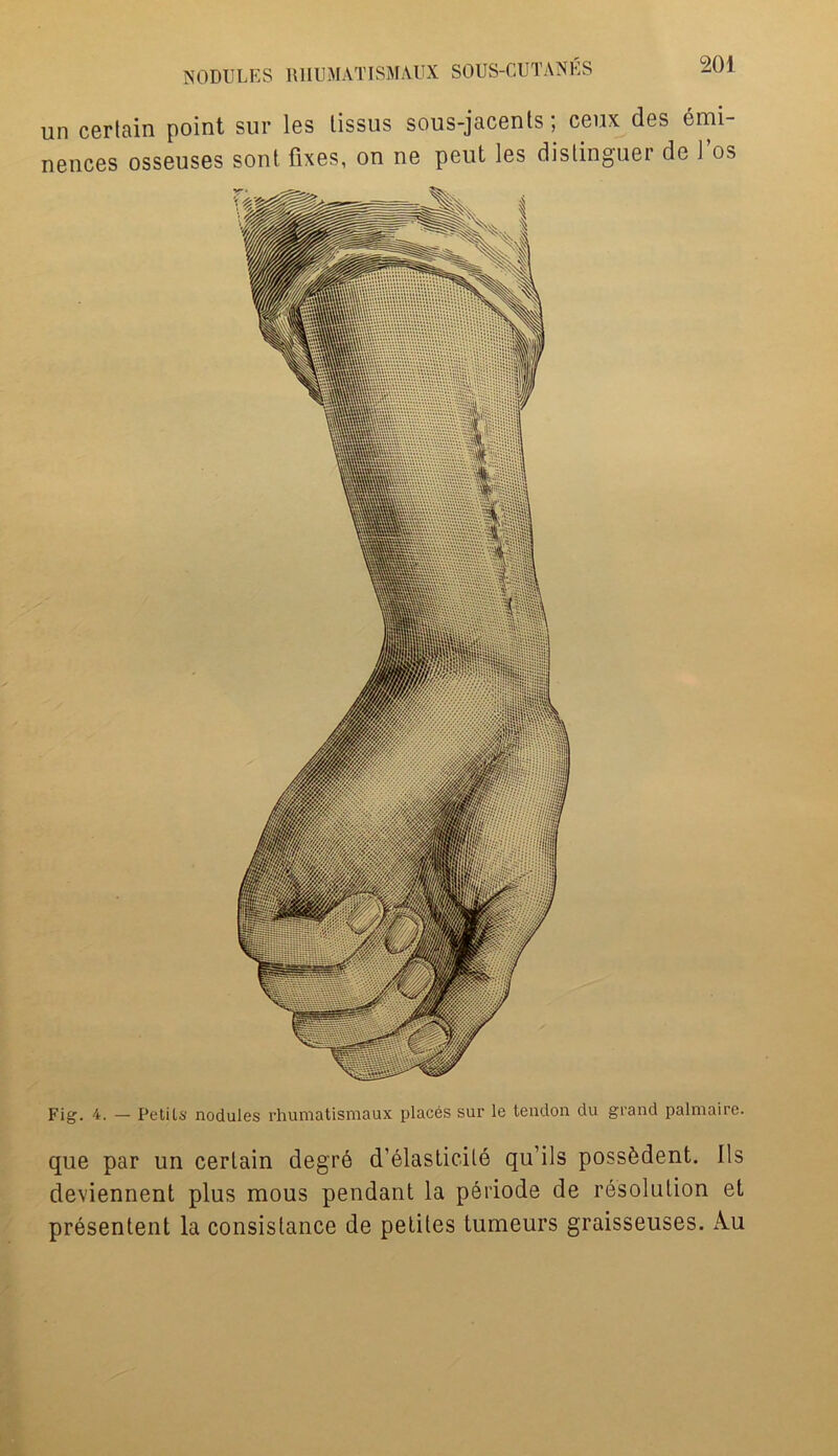 un certain point sur les tissus sous-jacents; ceux des emi- nences osseuses sont fixes, on ne peut les distinguer de 1 os Fig. 4. — Petits nodules rhumatismaux places sur le tendon du grand palmaire. que par un certain degre d’elasticile qu’ils possSdent. Ils deviennent plus mous pendant la periode de resolution et presentent la consistance de petites tumeurs graisseuses. Au