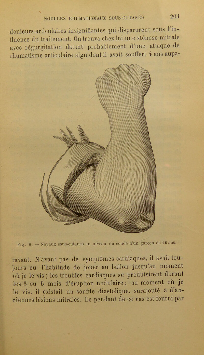 douleurs articulaires insignifiantes qui disparurent sous 1 in- fluence du fraitement. On trouva chez lui une stenose raitrale avec regurgitation datant probablement d’une atlaque de rhumatisme articulaire aigu dontil avait souffert 4 ans aupa- Fig. 6. — Noyaux sous-cutanes aa niveau du coude d’un gargon dc 10 ans. •ravant. N’ayant pas de symptomes cardiaques, il avait tou- jours eu l’habitude de jouer au ballon jusqu’au moment ou je le vis ; ies troubles cardiaques se produisirent durant les 5 ou 6 mois d’eruption nodulaire; au moment ou je le vis, il existait un souffle diastolique, surajoute a d an- ciennes lesions mitrales. Le pendant de ce cas est fourni par