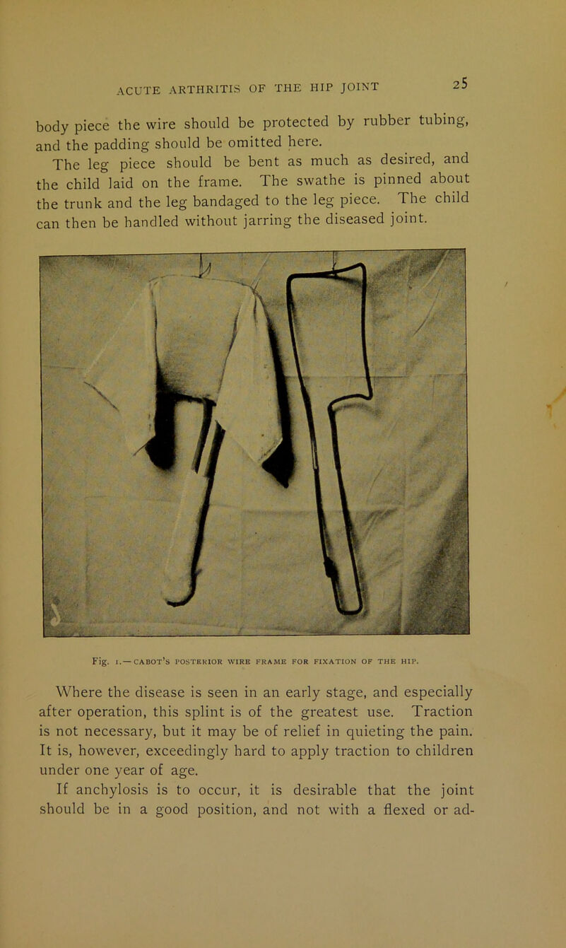 body piece the wire should be protected by rubber tubing, and the padding should be omitted here. The leg piece should be bent as much as desired, and the child laid on the frame. The swathe is pinned about the trunk and the leg bandaged to the leg piece. The child can then be handled without jarring the diseased joint. Fig. I. — Cabot’s posterior wire frame for fixation of the hip. Where the disease is seen in an early stage, and especially after operation, this splint is of the greatest use. Traction is not necessary, but it may be of relief in quieting the pain. It is, however, exceedingly hard to apply traction to children under one year of age. If anchylosis is to occur, it is desirable that the joint should be in a good position, and not with a flexed or ad-