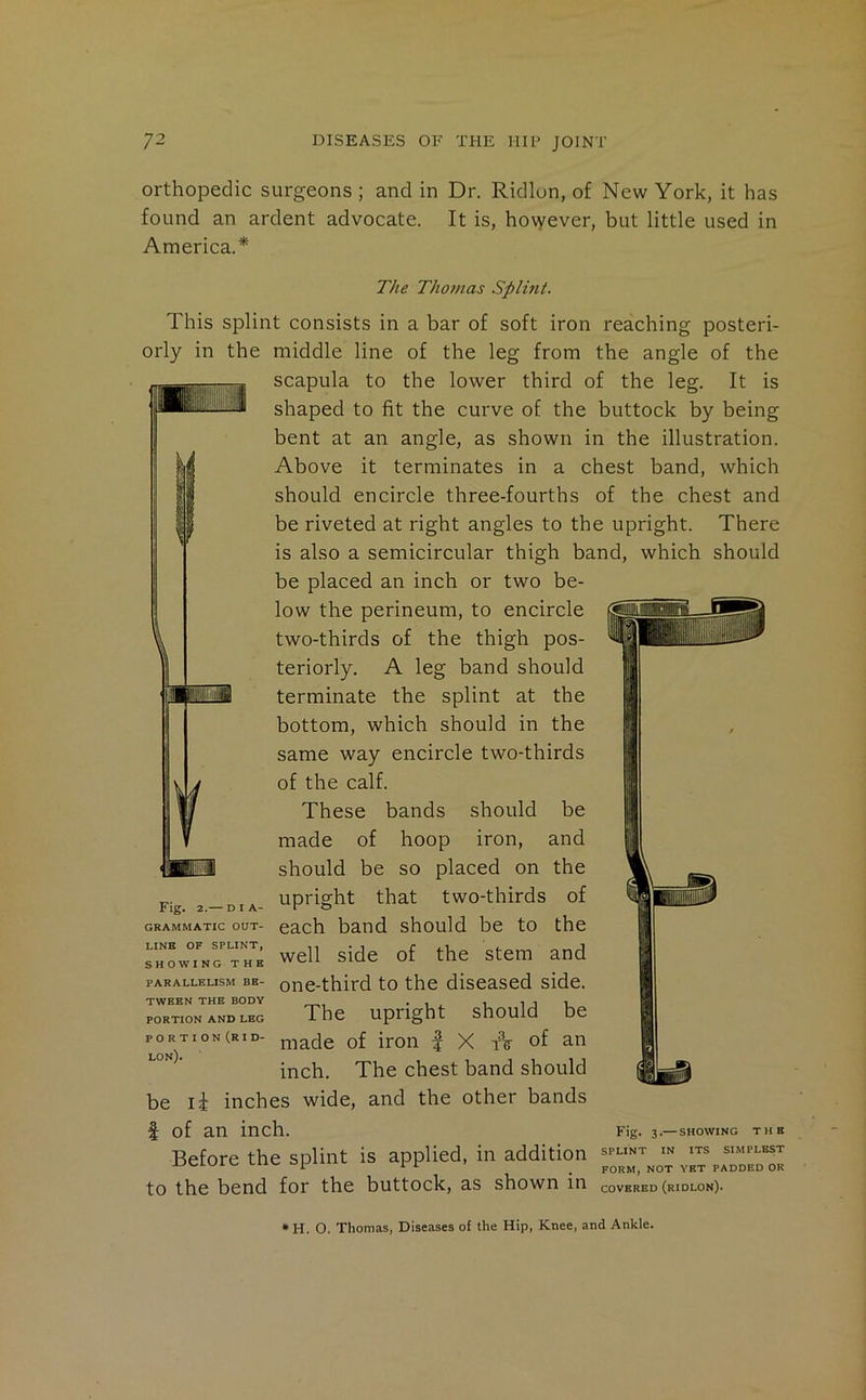 orthopedic surgeons ; and in Dr. Ridlun, of New York, it has found an ardent advocate. It is, however, but little used in America.* The Thomas Splmt. This splint consists in a bar of soft iron reaching posteri- orly in the middle line of the leg from the angle of the scapula to the lower third of the leg. It is shaped to fit the curve of the buttock by being bent at an angle, as shown in the illustration. Above it terminates in a chest band, which should encircle three-fourths of the chest and be riveted at right angles to the upright. There is also a semicircular thigh band, which should be placed an inch or two be- low the perineum, to encircle two-thirds of the thigh pos- teriorly. A leg band should terminate the splint at the bottom, which should in the same way encircle two-thirds of the calf. These bands should be made of hoop iron, and should be so placed on the upright that two-thirds of each band should be to the well side of the stem and one-third to the diseased side. The upright should be made of iron | X of an inch. The chest band should be li inches wide, and the other bands f of an inch. Fig. 3.—showing the Before the splint is applied, in addition ^punt in its simplest rr form, NOT YET PADDED OK to the bend for the buttock, as shown in COVERED (rIDLON). Fig. 2.— DIA- GRAMMATIC OUT- LINE OF SPLINT, S ROWING THE PARALLELISM BE- TWEEN THE BODY PORTION AND LEG PORTION (R I D- lon). * H. O. Thomas, Diseases of the Hip, Knee, and Ankle.