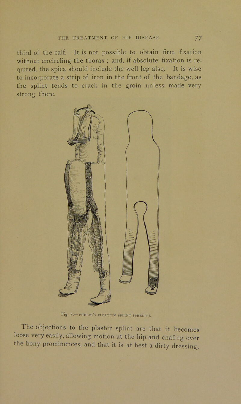 third of the calf. It is not possible to obtain firm fixation without encircling the thorax ; and, if absolute fixation is re- quired, the spica should include the well leg also. It is wise to incorporate a strip of iron in the front of the bandage, as the splint tends to crack in the groin unless made very strong there. Fig. S.— PHKI.rs’s KIXATION spi.int (phkpps). The objections to the plaster splint are that it becomes loose very easily, allowing motion at the hip and chafing over the bony prominences, and that it is at best a dirty dressing,