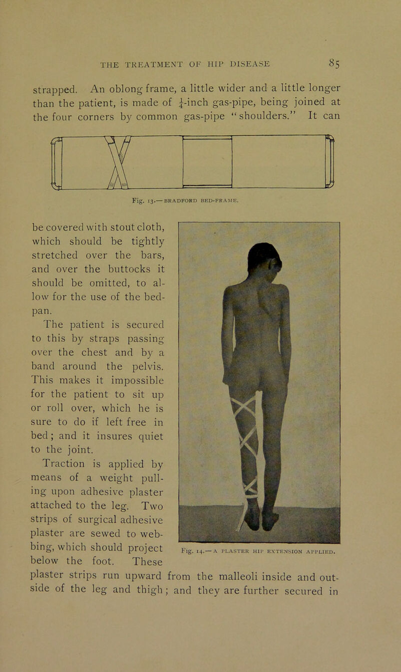 Strapped. An oblong frame, a little wider and a little longer than the patient, is made of ^-inch gas-pipe, being joined at the four corners by common gas-pipe “ shoulders.” It can be covered with stout cloth, which should be tightly stretched over the bars, and over the buttocks it should be omitted, to al- low for the use of the bed- pan. The patient is secured to this by straps passing over the chest and by a band around the pelvis. This makes it impossible for the patient to sit up or roll over, which he is sure to do if left free in bed ; and it insures quiet to the joint. Traction is applied by means of a weight pull- ing upon adhesive plaster attached to the leg. Two strips of surgical adhesive plaster are sewed to web- bing, which should project below the foot. These Fig. 14.— A PLASTER HIP EXTE.VSION APPLIED. plaster strips run upward from the malleoli inside and out- side of the leg and thigh ; and they are further secured in