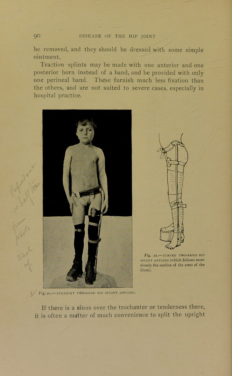 be removed, and they should be dressed with some simple ointment. Traction splints may be made with one anterior and one posterior horn instead of a band, and be provided with only one perineal band. Theise furnish much less fixation than the others, and are not suited to severe cases, especially in hospital practice. Fig. 22.— CURVED TWO-BAND HIP SPLINT APPLIED (which follows more closely the outline of the crest of the ilium). If there is a sinus over the trochanter or tenderness there, it is often a matter of much convenience to split the upright