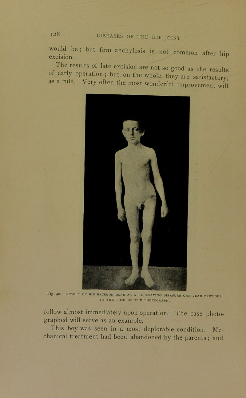 DISEASES OF THE HIP JOINT would be; but firm anchylosis is not common after bio excision. ^ The results of late excision are not so good as the results of early operation; but, on the whole, they are satisfactory as a rule. Very often the most wonderful improvement will Fig. 42. RESULT OF HIP EXCISION DONE AS A LIFE-SAVING MEASURE ONE YEAR PREVIOUS TO THE TIME OF THE PHOTOGRAPH. follow almost immediately upon operation. The case photo- graphed will serve as an example. This boy was seen in a most deplorable condition. Me- chanical treatment had been abandoned by the parents; and