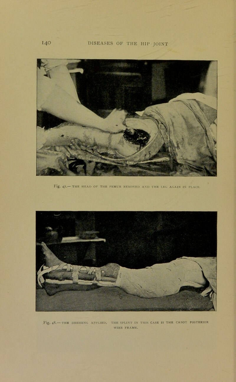 Fig. 47.— THE HEAD OF THE FEMUR REMOVED AND THE I.EC, AtDMN IN IM.ACE. Fig. 48.— THE DKUSSIXC; AP1‘[.IED. THE SPLINT IN THIS CASE IS THE CAUOT POSTERIOR WIRE FRAME.