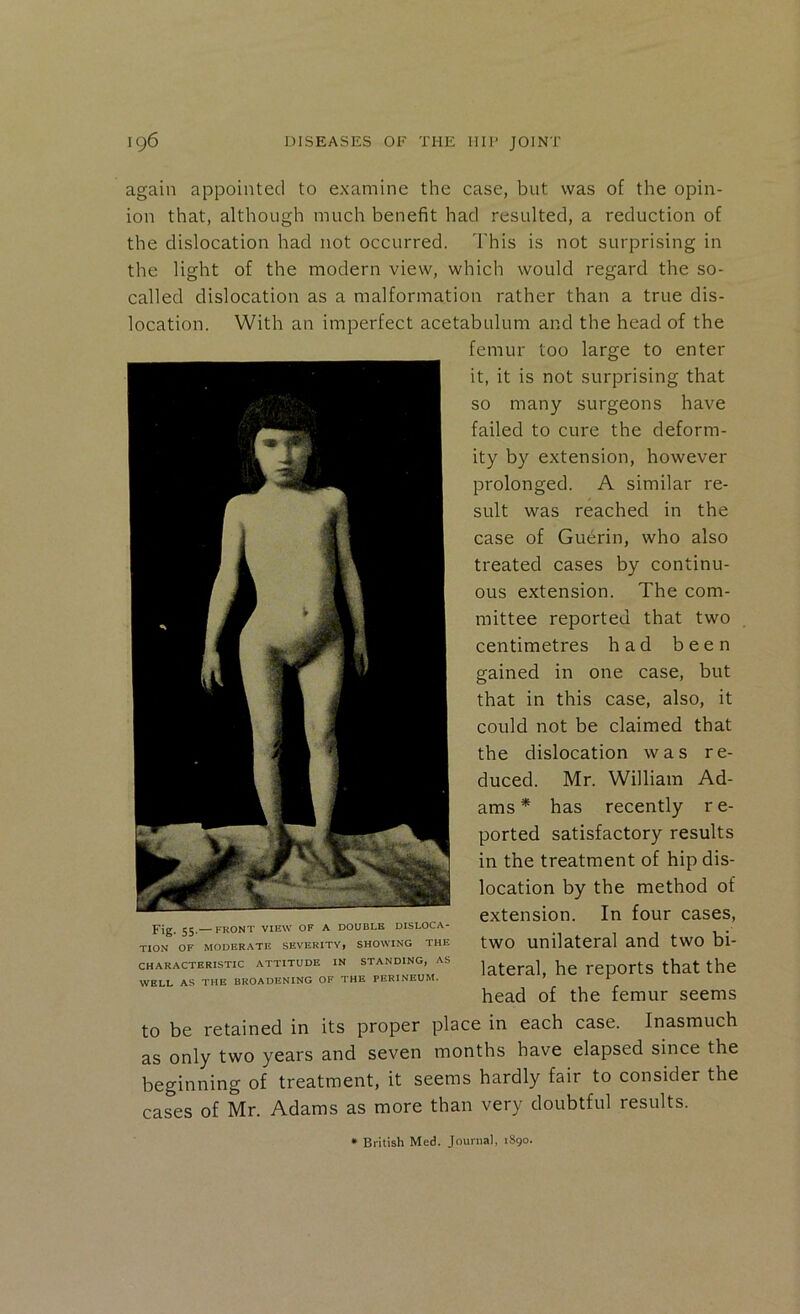 again appointed to examine the case, but was of the opin- ion that, although much benefit had resulted, a reduction of the dislocation had not occurred. 'I'his is not surprising in the light of the modern view, which would regard the so- called dislocation as a malformation rather than a true dis- location. With an imperfect acetabulum and the head of the femur too large to enter it, it is not surprising that so many surgeons have failed to cure the deform- ity by extension, however prolonged. A similar re- sult was reached in the case of Guerin, who also treated cases by continu- ous extension. The com- mittee reported that two centimetres had been gained in one case, but that in this case, also, it could not be claimed that the dislocation was re- duced. Mr. William Ad- ams * has recently r e- ported satisfactory results in the treatment of hip dis- location by the method of extension. In four cases, two unilateral and two bi- lateral, he reports that the head of the femur seems to be retained in its proper place in each case. Inasmuch as only two years and seven months have elapsed since the beginning of treatment, it seems hardly fair to consider the cases of Mr. Adams as more than very doubtful results. Fig. 55.— FRONT VIEW OF A DOUBLE DISLOCA- TION OF MODERATE SEVERITY, SHOWING THE CHARACTERISTIC ATTITUDE IN STANDING, AS WELL AS THE BROADENING OF THE PERINEUM. • British Med. Journal, 1890.