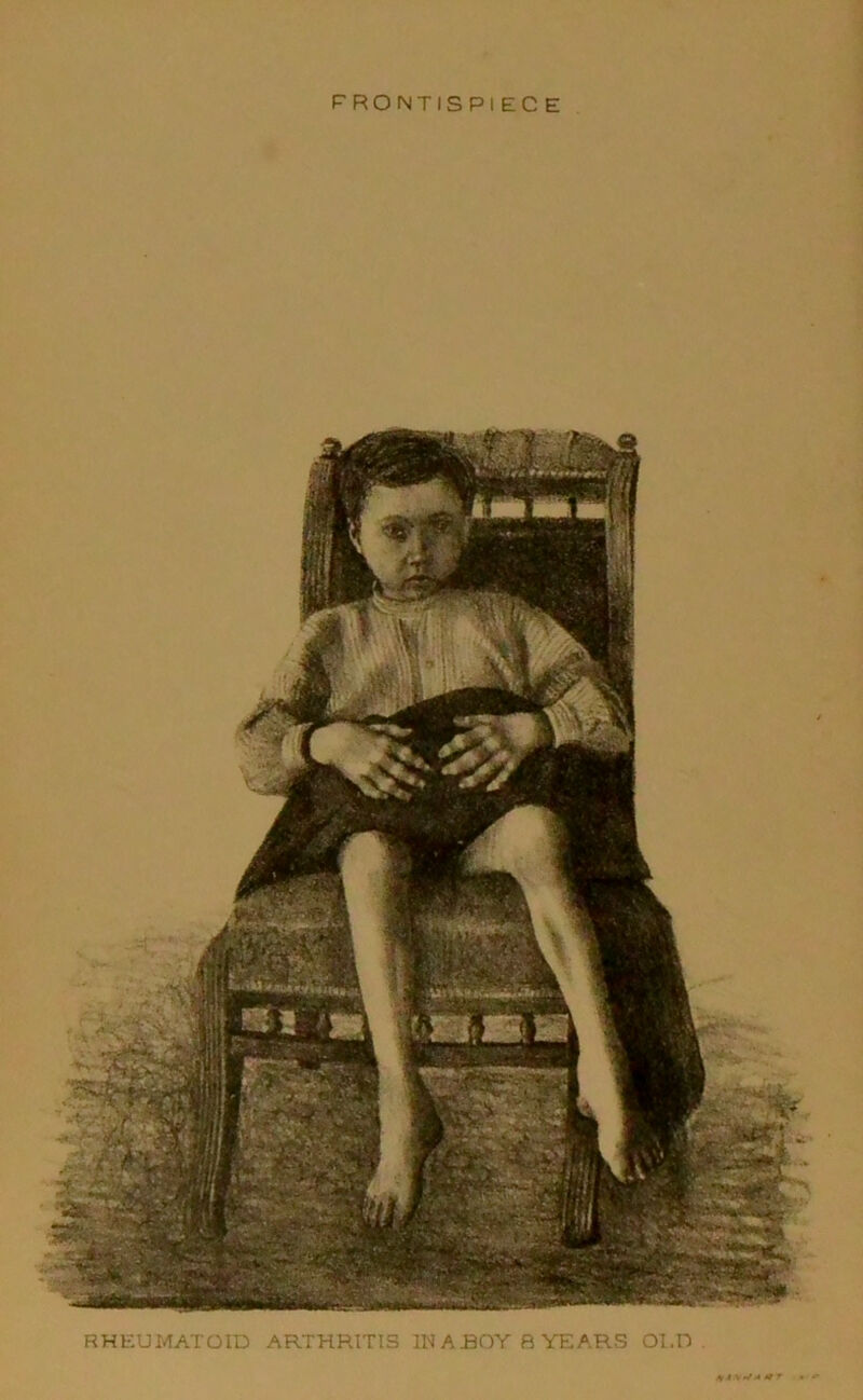 FRONTISPIECE RHEUMATOID ARTHRITIS IN A ROY B YEARS Ol.D S * \pfA *f