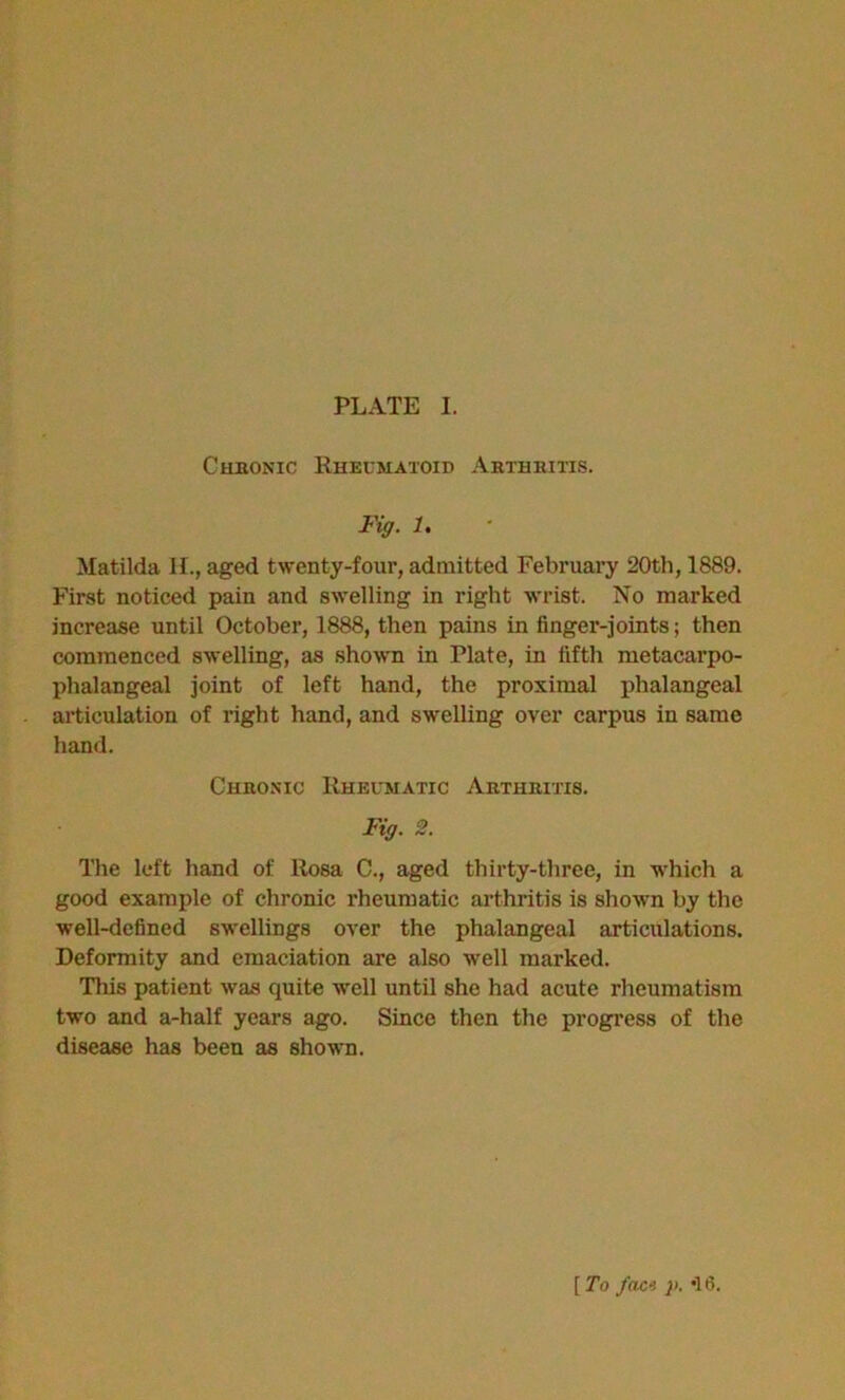 Chronic Rheumatoid Arthritis. Fig. 1. Matilda H., aged twenty-four, admitted February 20th, 1889. First noticed pain and swelling in right wrist. No marked increase until October, 1888, then pains in finger-joints; then commenced swelling, as shown in Plate, in fifth metacarpo- phalangeal joint of left hand, the proximal phalangeal articulation of right hand, and swelling over carpus in same hand. Chronic Rheumatic Arthritis. Fig. 2. The left hand of Rosa C., aged thirty-three, in which a good example of chronic rheumatic arthritis is shown by the well-defined swellings over the phalangeal articulations. Deformity and emaciation are also well marked. This patient was quite well until she had acute rheumatism two and a-half years ago. Since then the progress of the disease has been as shown. [ To fact }>. •! 6.